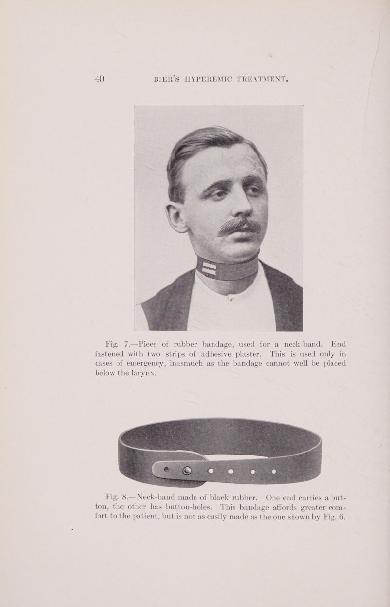 Fig. 7.—Piece of rubber bandage, used for a neck-band. End fastened with two strips of adhesive plaster. This is used only in cases of emergency, inasmuch as the bandage cannot well be placed below the larynx. Fig. 8.—Neck-band made of black rubber. One end carries a but- ton, the other has button-holes. This bandage affords greater com- fort to the patient, but is not as easily made as the one shown by Fig. 6.