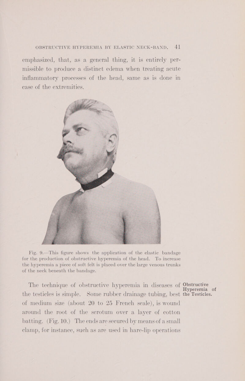emphasized, that, as a general thing, it is entirely per- missible to produce a distinct edema when treating acute inflammatory processes of the head, same as is done in case of the extremities. Fig. 9.—This figure shows the application of the elastic bandage for the production of obstructive hyperemia of the head. To increase the hyperemia a piece of soft felt is placed over the large venous trunks of the neck beneath the bandage. The technique of obstructive hyperemia in diseases of Obstructive : ai Sad : ; Hyperemia of the testicles is simple. Some rubber drainage tubing, best the Testicles. of medium size (about 20 to 25 French scale), is wound around the root of the scrotum over a layer of cotton batting. (Fig. 10.) The ends are secured by means of a small clamp, for instance, such as are used in hare-lip operations