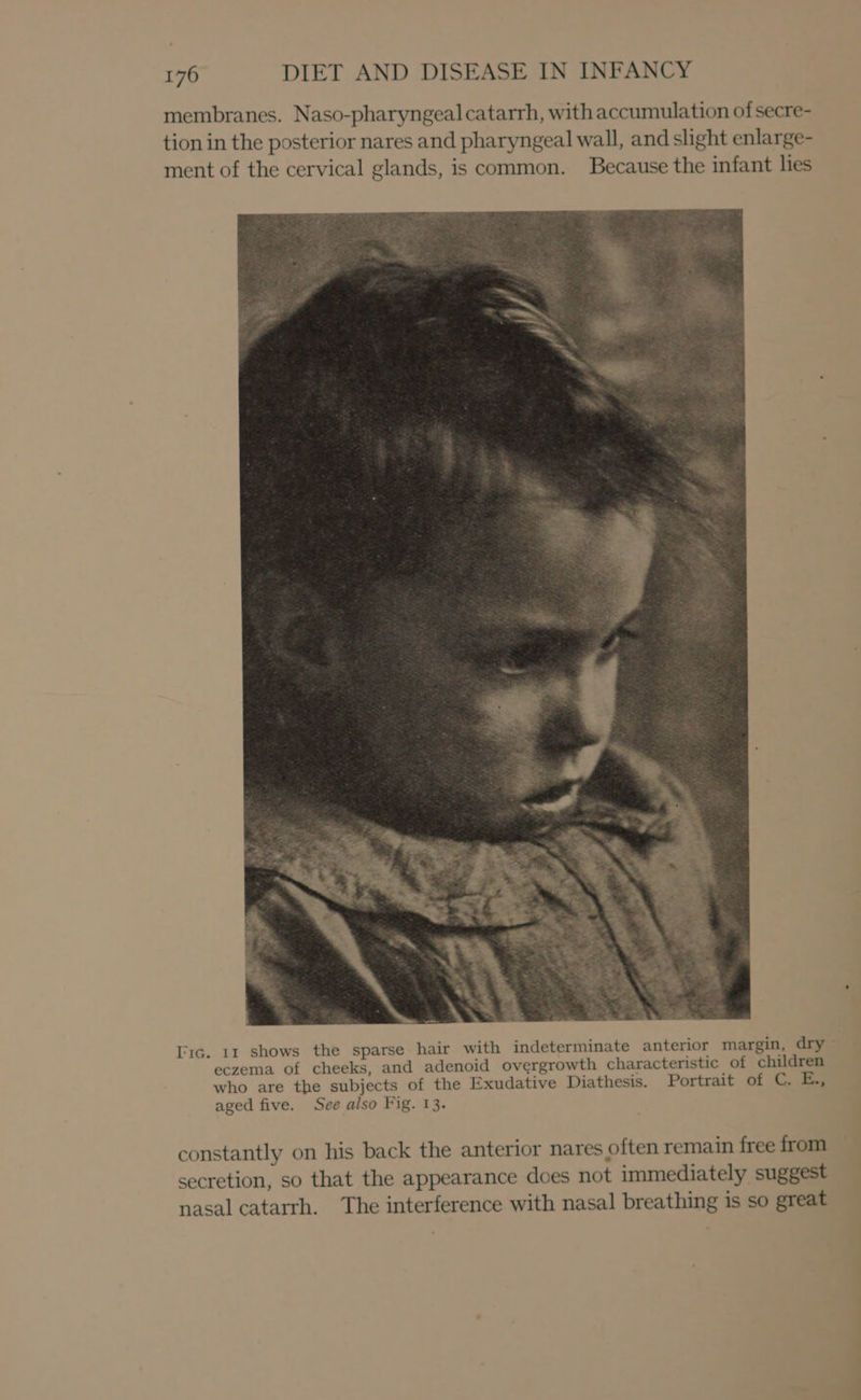 membranes. Naso-pharyngeal catarrh, with accumulation of secre- tion in the posterior nares and pharyngeal wall, and slight enlarge- ment of the cervical glands, is common. Because the infant lies ['1c. 11 shows the sparse hair with indeterminate anterior margin, dry eczema of cheeks, and adenoid overgrowth characteristic of children who are the subjects of the Exudative Diathesis. Portrait of C. E., aged five. See also Fig. 13. constantly on his back the anterior nares often remain free from secretion, so that the appearance does not immediately suggest nasal catarrh. The interference with nasal breathing is so great