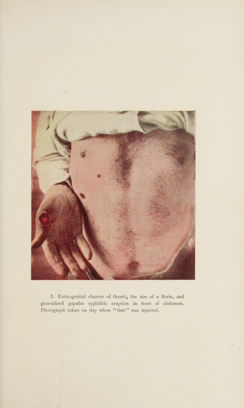  in, and f @ flor ize O generalized papular syphilitic eruption in front of abdomen. the s tal chancre of thumb, geni Extra- if Photograph taken on day when ‘‘ 606” was injected.