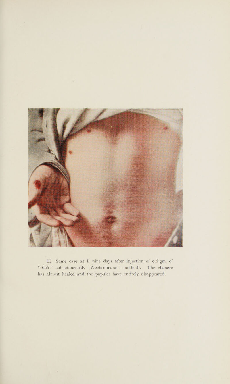  ** 606’ subcutaneously (Wechselmann’s method). The chancre has almost healed and the papules have entirely disappeared.