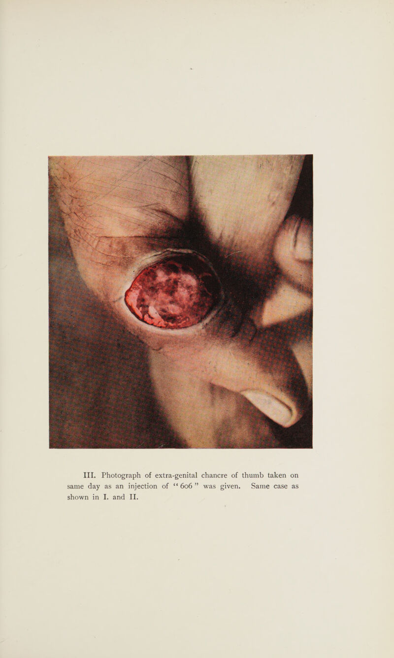  same day as an injection of ‘‘606” was given. Same case as shown in I. and II.