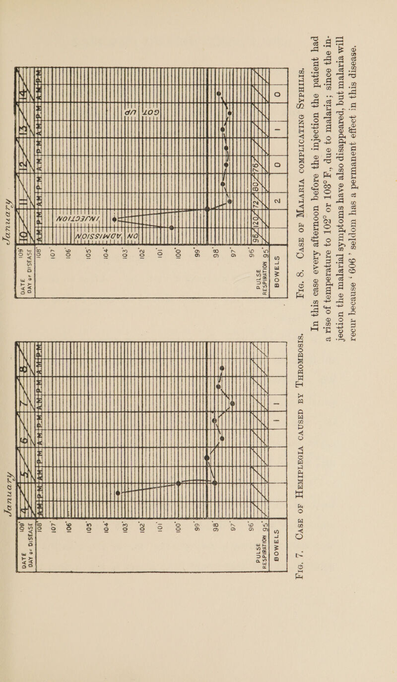     2 TTT 2  OATE \               Fall Ny. oh) r; Hl i = Ell >} i 8 TN tN | | ih e      DAY of DISEASE   LW Ne ETT TN TN — eT REN = NTT | NE si BOWELS DAY of DISEASE PULSE   Fic, 7. Case or HEMIPLEGIA CAUSED BY THROMBOSIS.