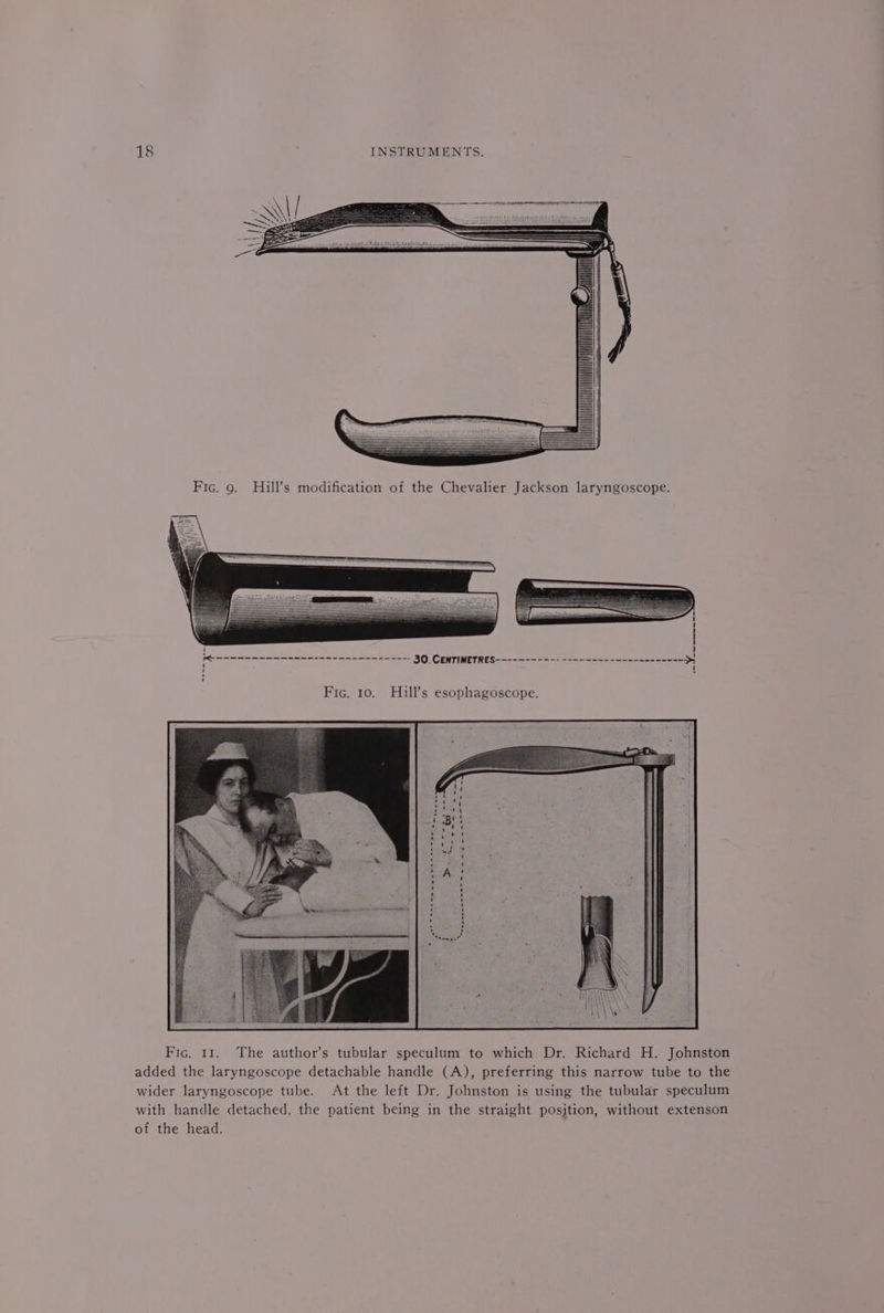 Fic. 9. Hill’s modification of the Chevalier Jackson laryngoscope. Fic. 11. The author’s tubular speculum to which Dr. Richard H. Johnston added the laryngoscope detachable handle (A), preferring this narrow tube to the wider laryngoscope tube. At the left Dr. Johnston is using the tubular speculum with handle detached, the patient being in the straight position, without extenson of the head.