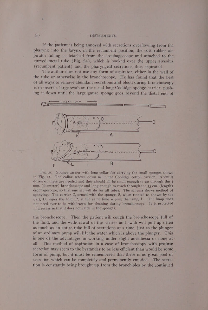 If the patient is being annoyed with secretions overflowing from the pharynx into the larynx in the recumbent position, the soft rubber as- pirator tubing is detached from the esophagoscope and attached to the curved metal tube (Fig. 24), which is hooked over the upper alveolus (recumbent patient) and the pharyngeal secretions thus aspirated. The author does not use any form of aspirator, either in the wall of the tube or otherwise in the bronchoscope. He has found that the best of all ways to remove abundant secretions and blood during bronchoscopy is to insert a large swab on the usual long Coolidge sponge-carrier, push- ing it down until the large gauze sponge goes beyond the distal end of —\— coLLaAR IOCM —_ ES ee ————— J Fig. 25. Sponge carrier with long collar for carrying the small sponges shown in Fig. 27. The collar screws down as in the Coolidge cotton carrier. About a dozen of these are needed and they should all be small enough to go through the 4 mm. (diameter) bronchoscope and long enough to reach through the 53 cm. (length) esophagoscope, so that one set will do for all tubes. The schema shows method of sponging. The carrier C, armed with the sponge, S, when rotated as shown by the dart, D, wipes the field, P, at the same time wiping the lamp, L. The lamp does not need ever to be withdrawn for cleaning during bronchoscopy. It is protected in a recess so that it does not catch in the sponges. the bronchoscope. ‘Then the patient will cough the bronchoscope full of the fluid, and the withdrawal of the carrier and swab will pull up often as much as an entire tube full of secretions at a time, just as the plunger of an ordinary pump will lift the water which is above the plunger. This is one of the advantages in working under slight anesthesia or none at all. This method of aspiration in a case of bronchoscopy with profuse secretion may seem to the bystander to be less efficient than would be some form of pump, but it must be remembered that there is no great pool of secretion which can be completely and permanently emptied. The secre- tion is constantly being brought up from the bronchioles by the continued