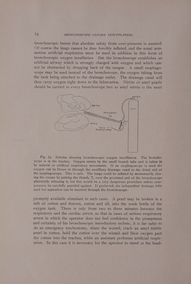 bronchoscopic lumen that absolute safety from over-pressure is assured. Of course the lungs cannot be thus forcibly inflated, and the usual arm- motion artificial respiration must be used in addition in this form of bronchoscopic oxygen insufflation. But the bronchoscope establishes an artificial airway which is strongly charged with oxygen and which can- not be obstructed by dropping back of the tongue. A small esophago- scope may be used instead of the bronchoscope, the oxygen tubing from the tank being attached to the drainage outlet. The drainage canal will thus carry oxygen right down to the bifurcation. Nitrite of amyl pearls should be carried in every bronchoscope box as amyl nitrite is the most OXYGEN Ba 2a eee Mouth of Lalient = ss SS. aA M. be \ —— 7 a os a, Left Luny Fig. 63. Schema showing bronchoscopic oxygen insufflation. The broncho- scope is in the trachea. Oxygen enters by the small branch tube and is taken in by natural or artificial respiratory movements. If an esophagoscope is used the oxygen can be blown in through the auxilliary drainage canal to the distal end of the esophagoscope. This is safe. The lungs could be inflated by momentarily clos- ing the escape by putting the thumb, T, over the proximal end of the bronchoscope alternately releasing it, but this would be a very dangerous procedure unless over- pressure be carefully guarded against. If preferred, the independent drainage tube used for aspiration can be inserted through the bronchoscope. promptly available stimulant in such cases. A pearl may be broken in a tuft of cotton and thrown, cotton and all, into the wash bottle of the oxygen tank. There is only from two to three minutes between the respiratory and the cardiac arrest, so that in cases of serious respiratory arrest in which the operator does not feel confidence in the promptness and certainty of his bronchoscopic introductory technic, it is far safer to do an emergency tracheotomy, dilate the wound, crack an amyl nitrite pearl in cotton, hold the cotton over the wound and blow oxygen past the cotton into the trachea, while an assistant performs artificial respir- ation. In this case it is necessary for the operator to stand at the head-