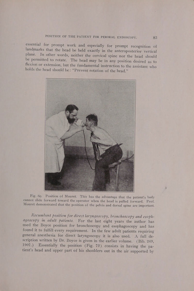 essential for prompt work and especially for prompt recognition of landmarks that the head be held exactly in the anteroposterior vertical plane. In other words, neither the cervical spine nor the head should be permitted to rotate. The head may be in any position desired as to flexion or extension, but the fundamental instruction to the assistant who holds the head should be: “Prevent rotation of the head.” Fig. 69. Position of Mouret. This has the advantage that the patient's body cannot slide forward toward the operator when the head is pulled forward. Prof. Mouret demonstrated that the position of the pelvis and dorsal spine are important. Recumbent position for direct laryngoscopy, bronchoscopy and esoph- agoscopy in adult patients. For the last eight years the author has used the Boyce position for bronchoscopy and esophagoscopy and has found it to fulfill every requirement. In the few adult patients requiring general anesthesia for direct laryngoscopy it is also used. A full de- scription written by Dr. Boyce is given in the earlier volume. (Bib. 269, 1907.) Essentially the position (Fig. %2) consists in having the pa- tient’s head and upper part of his shoulders out in the air supported by