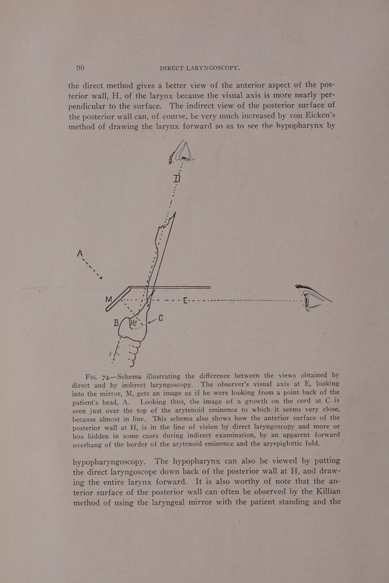 the direct method gives a better view of the anterior aspect of the pos- terior wall, H, of the larynx because the visual axis is more nearly per- pendicular to the surface. The indirect view of the posterior surface of the posterior wall can, of course, be very much increased by von Ejicken’s method of drawing the larynx forward so as to see the hypopharynx by Fic. 74.—Schema illustrating the difference between the views obtained by direct and by indirect laryngoscopy. The observer’s visual axis at E, looking into the mirror, M, gets an image as if he were looking from a point back of the patient's head, A. Looking thus, the image of a growth on the cord at.aas seen just over the top of the arytenoid eminence to which it seems very close, because almost in line. This schema also shows how the anterior surface of the posterior wall at H, is in the line of vision by direct laryngoscopy and more or less hidden in some cases during indirect examination, by an apparent forward overhang of the border of the arytenoid eminence and the aryepiglottic fold. hypopharyngoscopy. The hypopharynx can also be viewed by putting the direct laryngoscope down back of the posterior wall at H, and draw- ing the entire larynx forward. It is also worthy of note that the an- terior surface of the posterior wall can often be observed by the Killian method of using the laryngeal mirror with the patient standing and the