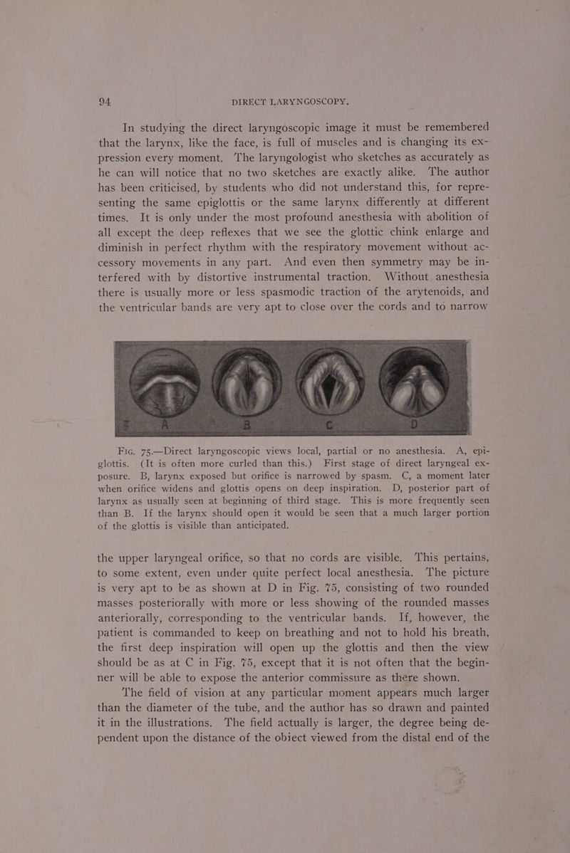 In studying the direct laryngoscopic image it must be remembered that the larynx, like the face, is full of muscles and is changing its ex- pression every moment. ‘The laryngologist who sketches as accurately as he can will notice that no two sketches are exactly alike. The author has been criticised, by students who did not understand this, for repre- senting the same epiglottis or the same larynx differently at different times. It is only under the most profound anesthesia with abolition of all except the deep reflexes that we see the glottic chink enlarge and diminish in perfect rhythm with the respiratory movement without ac- cessory movements in any part. And even then symmetry may be in- terfered with by distortive instrumental traction. Without anesthesia there is usually more or less spasmodic traction of the arytenoids, and the ventricular bands are very apt to close over the cords and to narrow Fic. 75.—Direct laryngoscopic views local, partial or no anesthesia. A, epi- glottis. (It is often more curled than this.) First stage of direct laryngeal ex- posure. B, larynx exposed but orifice is narrowed by spasm. C, a moment later when orifice widens and glottis opens on deep inspiration. D, posterior part of larynx as usually seen at beginning of third stage. This is more frequently seen than B. If the larynx should open it would be seen that a much larger portion of the glottis is visible than anticipated. the upper laryngeal orifice, so that no cords are visible. This pertains, to some extent, even under quite perfect local anesthesia. The picture is very apt to be as shown at D in Fig. 75, consisting of two rounded masses posteriorally with more or less showing of the rounded masses anteriorally, corresponding to the ventricular bands. If, however, the patient is commanded to keep on breathing and not to hold his breath, the first deep inspiration will open up the glottis and then the view should be as at C in Fig. 75, except that it is not often that the begin- ner will be able to expose the anterior commissure as there shown. The field of vision at any particular moment appears much larger than the diameter of the tube, and the author has so drawn and painted it in the illustrations. ‘The field actually is larger, the degree being de- pendent upon the distance of the obiect viewed from the distal end of the