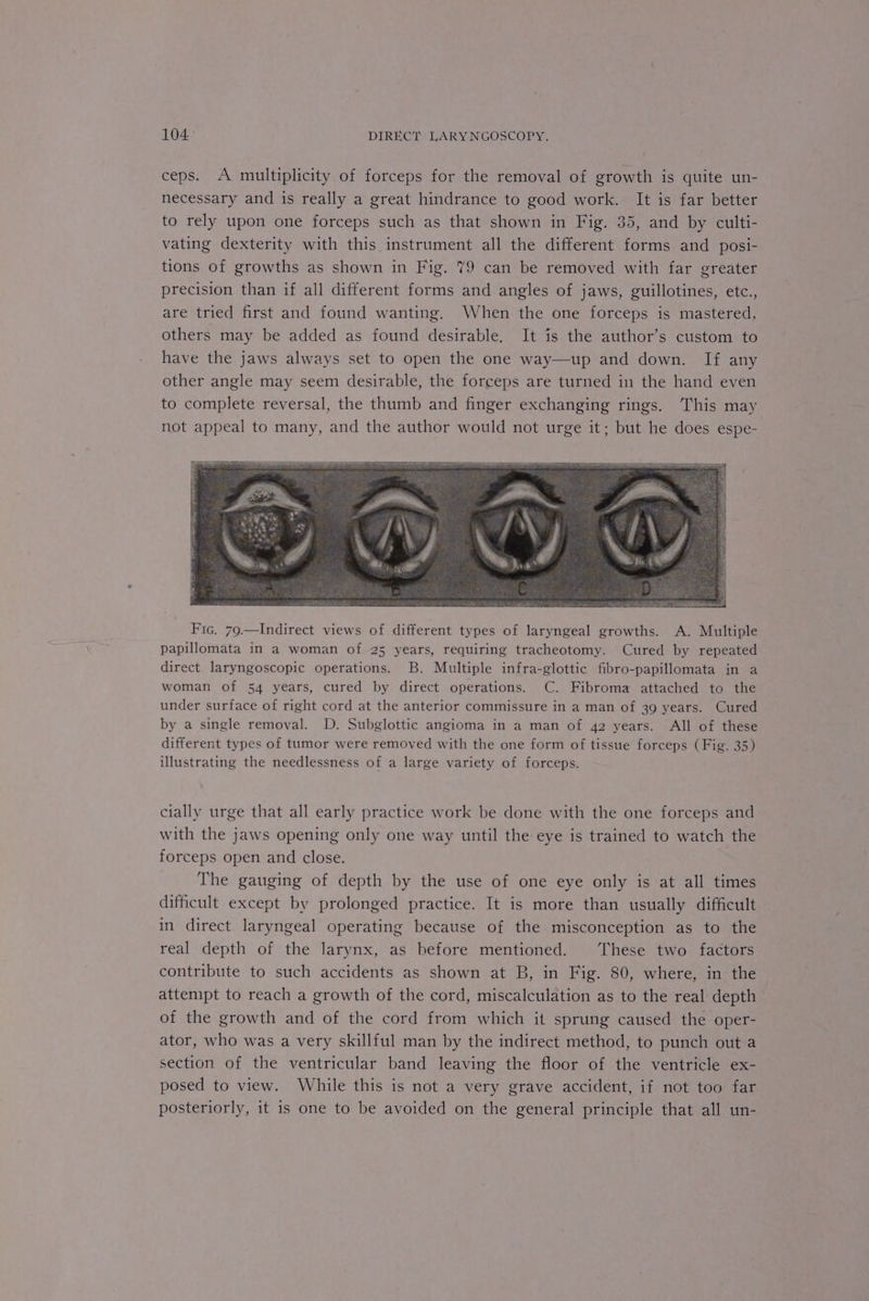 ceps. A multiplicity of forceps for the removal of growth is quite un- necessary and is really a great hindrance to good work. It is far better to rely upon one forceps such as that shown in Fig. 35, and by culti- vating dexterity with this instrument all the different forms and posi- tions of growths as shown in Fig. 79 can be removed with far greater precision than if all different forms and angles of jaws, guillotines, etc., are tried first and found wanting. When the one forceps is mastered, others may be added as found desirable. It is the author’s custom to have the jaws always set to open the one way—up and down. If any other angle may seem desirable, the forceps are turned in the hand even to complete reversal, the thumb and finger exchanging rings. This may not appeal to many, and the author would not urge it; but he does espe- Fic. 79.—Indirect views of different types of laryngeal growths. A. Multiple papillomata in a woman of 25 years, requiring tracheotomy. Cured by repeated direct laryngoscopic operations. B. Multiple infra-glottic fibro-papillomata in a woman of 54 years, cured by direct operations. C. Fibroma attached to the under surface of right cord at the anterior commissure in a man of 39 years. Cured by a single removal. D. Subglottic angioma in a man of 42 years. All of these different types of tumor were removed with the one form of tissue forceps (Fig. 35) illustrating the needlessness of a large variety of forceps. cially urge that all early practice work be done with the one forceps and with the jaws opening only one way until the eye is trained to watch the forceps open and close. The gauging of depth by the use of one eye only is at all times difficult except by prolonged practice. It is more than usually difficult in direct laryngeal operating because of the misconception as to the real depth of the larynx, as before mentioned. These two factors contribute to such accidents as shown at B, in Fig. 80, where, in the attempt to reach a growth of the cord, miscalculation as to the real depth of the growth and of the cord from which it sprung caused the oper- ator, who was a very skillful man by the indirect method, to punch out a section of the ventricular band leaving the floor of the ventricle ex- posed to view. While this is not a very grave accident, if not too far posteriorly, it is one to be avoided on the general principle that all un-