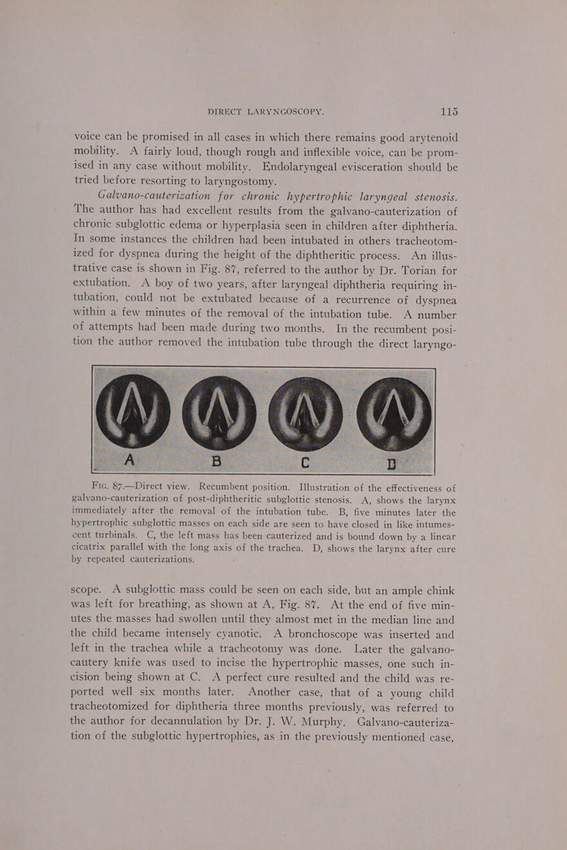voice can be promised in all cases in which there remains good arytenoid mobility. A fairly loud, though rough and inflexible voice, can be prom- ised in any case without mobility. Endolaryngeal evisceration should be tried before resorting to laryngostomy. Galvano-cauterization for chronic hypertrophic laryngeal stenosis. The author has had excellent results from the galvano-cauterization of chronic subglottic edema or hyperplasia seen in children after diphtheria. In some instances the children had been intubated in others tracheotom- ized for dyspnea during the height of the diphtheritic process. An illus- trative case is shown in Fig. 87, referred to the author by Dr. Torian for extubation. A boy of two years, after laryngeal diphtheria requiring in- tubation, could not be extubated because of a recurrence of dyspnea within a few minutes of the removal of the intubation tube. A number of attempts had been made during two months. In the recumbent posi- tion the author removed the intubation tube through the direct laryngo- Fic. 87—Direct view. Recumbent position. Illustration of the effectiveness of galvano-cauterization of post-diphtheritic subglottic stenosis. A, shows the larynx immediately after the removal of the intubation tube. B, five minutes later the hypertrophic subglottic masses on each side are seen to have closed in like intumes- cent turbinals. C, the left mass has been cauterized and is bound down by a linear cicatrix parallel with the long axis of the trachea. D, shows the larynx after cure by repeated cauterizations. : scope. A subglottic mass could be seen on each side, but an ample chink was left for breathing, as shown at A, Fig. 87. At the end of five min- utes the masses had swollen until they almost met in the median line and the child became intensely cyanotic. A bronchoscope was inserted and left in the trachea while a tracheotomy was done. Later the galvano- cautery knife was used to incise the hypertrophic masses, one such in- cision being shown at C. A perfect cure resulted and the child was re- ported well six months later. Another case, that of a young child tracheotomized for diphtheria three months previously, was referred to the author for decannulation by Dr. J. W. Murphy. Galvano-cauteriza- tion cf the subglottic hypertrophies, as in the previously mentioned case,