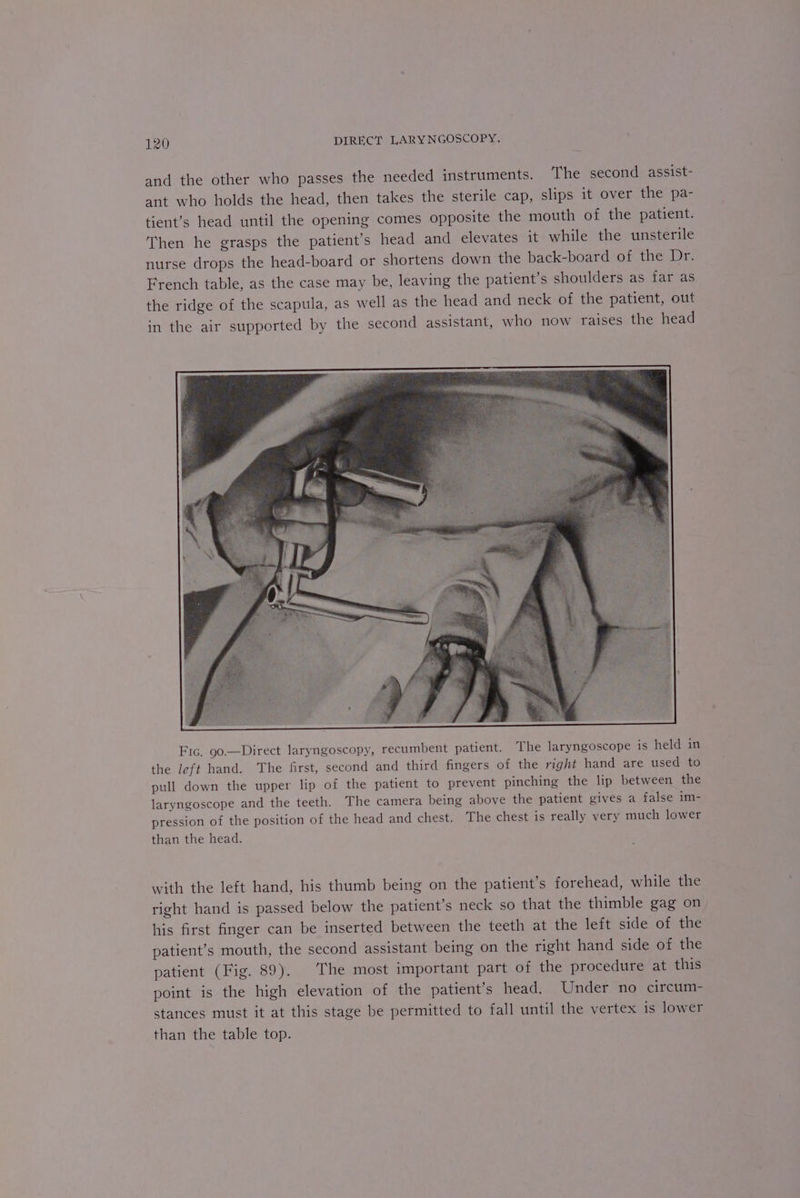 and the other who passes the needed instruments. The second assist- ant who holds the head, then takes the sterile cap, slips it over the pa- tient’s head until the opening comes opposite the mouth of the patient. Then he grasps the patient’s head and elevates it while the unsterile nurse drops the head-board or shortens down the back-board of the Dr. French table, as the case may be, leaving the patient’s shoulders as far as the ridge of the scapula, as well as the head and neck of the patient, out in the air supported by the second assistant, who now raises the head Fic. 90.—Direct laryngoscopy, recumbent patient. The laryngoscope is held in the left hand. The first, second and third fingers of the right hand are used to pull down the upper lip of the patient to prevent pinching the lip between the laryngoscope and the teeth. The camera being above the patient gives a false im- pression of the position of the head and chest. The chest is really very much lower than the head. with the left hand, his thumb being on the patient’s forehead, while the right hand is passed below the patient's neck so that the thimble gag on his first finger can be inserted between the teeth at the left side of the patient’s mouth, the second assistant being on the right hand side of the patient (Fig. 89). The most important part of the procedure at this point is the high elevation of the patient's head. Under no circum- stances must it at this stage be permitted to fall until the vertex is lower than the table top.