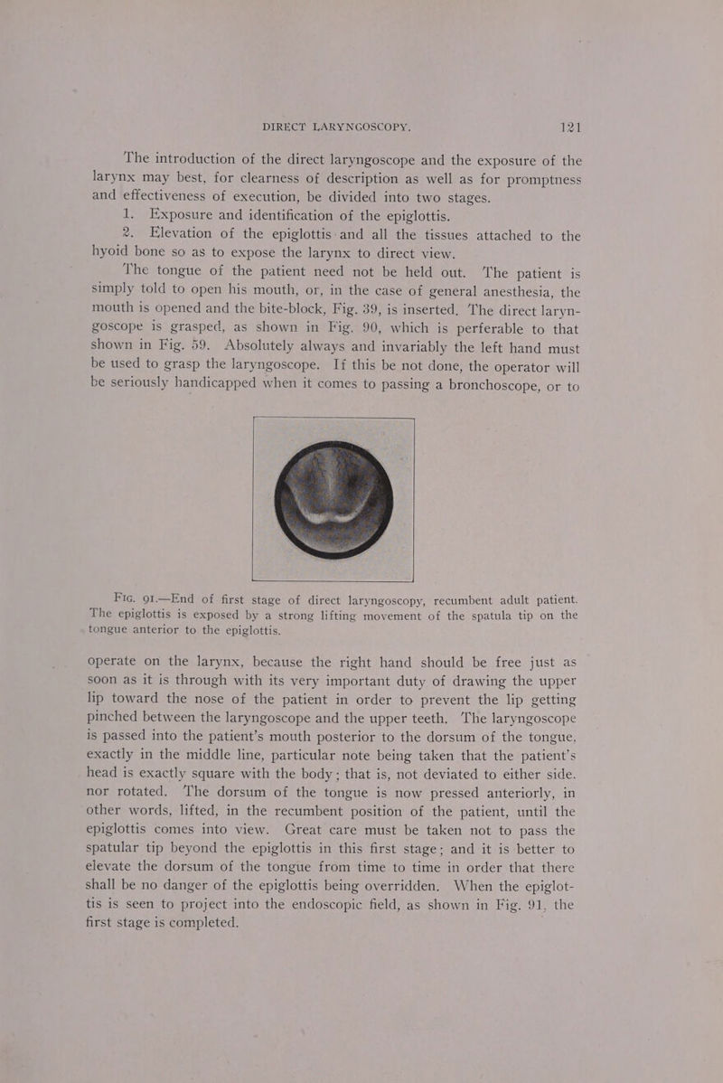 The introduction of the direct laryngoscope and the exposure of the larynx may best, for clearness of description as well as for promptness and effectiveness of execution, be divided into two stages. 1. Exposure and identification of the epiglottis. %. Elevation of the epiglottis and all the tissues attached to the hyoid bone so as to expose the larynx to direct view. The tongue of the patient need not be held out. ‘The patient is simply told to open his mouth, or, in the case of general anesthesia, the mouth is opened and the bite-block, Fig. 39, is inserted, The direct laryn- goscope is grasped, as shown in Fig. 90, which is perferable to that shown in Fig. 59. Absolutely always and invariably the left hand must be used to grasp the laryngoscope. If this be not done, the operator will be seriously handicapped when it comes to passing a bronchoscope, or to Fic. 91.—End of first stage of direct laryngoscopy, recumbent adult patient. The epiglottis is exposed by a strong lifting movement of the spatula tip on the tongue anterior to the epiglottis. operate on the larynx, because the right hand should be free just as soon as it is through with its very important duty of drawing the upper lip toward the nose of the patient in order to prevent the lip getting pinched between the laryngoscope and the upper teeth. The laryngoscope is passed into the patient’s mouth posterior to the dorsum of the tongue, exactly in the middle line, particular note being taken that the patient’s head is exactly square with the body; that is, not deviated to either side. nor rotated. The dorsum of the tongue is now pressed anteriorly, in other words, lifted, in the recumbent position of the patient, until the epiglottis comes into view. Great care must be taken not to pass the spatular tip beyond the epiglottis in this first stage: and it is better to elevate the dorsum of the tongue from time to time in order that there shall be no danger of the epiglottis being overridden. When the epiglot- tis is seen to project into the endoscopic field, as shown in Fig. 91, the first stage is completed.