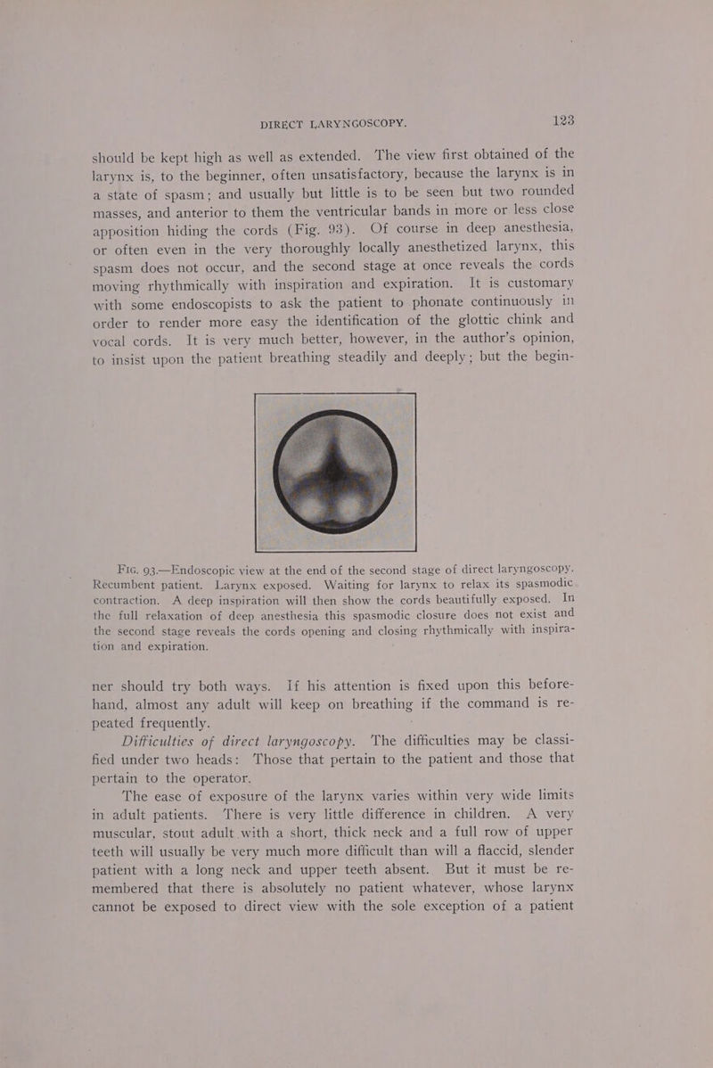 should be kept high as well as extended. The view first obtained of the larynx is, to the beginner, often unsatisfactory, because the larynx is in a state of spasm; and usually but little is to be seen but two rounded masses, and anterior to them the ventricular bands in more or less close apposition hiding the cords (Fig. 93). Of course in deep anesthesia, or often even in the very thoroughly locally anesthetized larynx, this spasm does not occur, and the second stage at once reveals the cords moving rhythmically with inspiration and expiration. It is customary with some endoscopists to ask the patient to phonate continuously 11 order to render more easy the identification of the glottic chink and vocal cords. It is very much better, however, in the author’s opinion, to insist upon the patient breathing steadily and deeply; but the begin- Fic. 93.—Endoscopic view at the end of the second stage of direct laryngoscopy. Recumbent patient. Larynx exposed. Waiting for larynx to relax its spasmodic contraction. A deep inspiration will then show the cords beautifully exposed, In the full relaxation of deep anesthesia this spasmodic closure does not exist and the second stage reveals the cords opening and closing rhythmically with inspira- tion and expiration. ner should try both ways. If his attention is fixed upon this before- hand, almost any adult will keep on breathing if the command is re- peated frequently. Difficulties of direct laryngoscopy. ‘The difficulties may be classi- fied under two heads: Those that pertain to the patient and those that pertain to the operator. The ease of exposure of the larynx varies within very wide limits in adult patients. ‘There is very little difference in children. A very muscular, stout adult with a short, thick neck and a full row of upper teeth will usually be very much more difficult than will a flaccid, slender patient with a long neck and upper teeth absent. But it must be re- membered that there is absolutely no patient whatever, whose larynx cannot be exposed to direct view with the sole exception of a patient