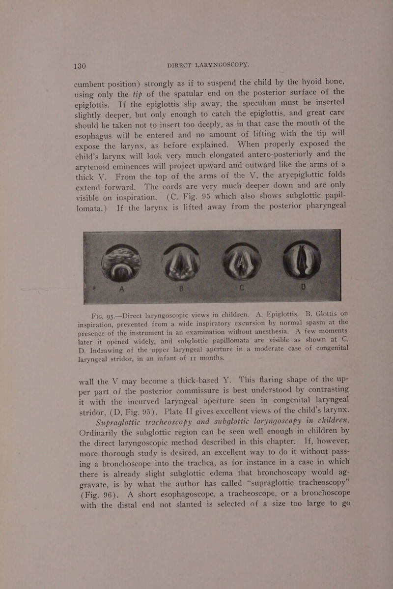 cumbent position) strongly as if to suspend the child by the hyoid bone, using only the tip of the spatular end on the posterior surface of the epiglottis. If the epiglottis slip away, the speculum must be inserted slightly deeper, but only enough to catch the epiglottis, and great care should be taken not to insert too deeply, as in that case the mouth of the esophagus will be entered and no amount of lifting with the tip will expose the larynx, as before explained. When properly exposed the child’s larynx will look very much elongated antero-posteriorly and the arytenoid eminences will project upward and outward like the arms of a thick V. From the top of the arms of the V, the aryepigluttic folds extend forward. The cords are very much deeper down and are only visible on inspiration. (C. Fig. 95 which also shows subglottic papil- lomata.) If the larynx is lifted away from the posterior pharyngeal Fic. 95.—Direct laryngoscopic views in children. A. Epiglottis. B. Glottis on inspiration, prevented from a wide inspiratory excursion by normal spasm at the presence of the instrument in an examination without anesthesia. A few moments later it opened widely, and subglottic papillomata are visible as shown at C. D. Indrawing of the upper laryngeal aperture in a moderate case of congenital laryngeal stridor, in an infant of 11 months. wall the V may become a thick-based Y. This flaring shape of the up- per part of the posterior commissure is best understood by contrasting it with the incurved laryngeal aperture seen in congenital laryngeal stridor, (D, Fig. 95). Plate Il gives excellent views of the child’s larynx. Supraglottic tracheoscopy and subglottic taryngoscopy in children. Ordinarily the subglottic region can be seen well enough in children by the direct laryngoscopic method described in this chapter. If, however, more thorough study is desired, an excellent way to do it without pass- ing a bronchoscope into the trachea, as for instance in a case in which there is already slight subglottic edema that bronchoscopy would ag- gravate, is by what the author has called “supraglottic tracheoscopy” (Fig. 96). A short esophagoscope, a tracheoscope, or a bronchoscope with the distal end not slanted is selected of a size too large to go