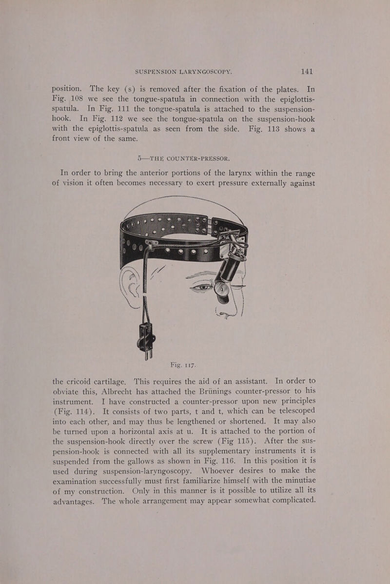 position. The key (s) is removed after the fixation of the plates. In Fig. 108 we see the tongue-spatula in connection with the epiglottis- spatula. In Fig. 111 the tongue-spatula is attached to the suspension- hook. In Fig. 112 we see the tongue-spatula on the suspension-hook with the epiglottis-spatula as seen from the side. Fig. 113 shows a front view of the same. 5—THE COUNTER-PRESSOR. In order to bring the anterior portions of the larynx within the range of vision it often becomes necessary to exert pressure externally against the cricoid cartilage. ‘This requires the aid of an assistant. In order to obviate this, Albrecht has attached the Briinings counter-pressor to his instrument. I have constructed a counter-pressor upon new principles (Fig. 114). It consists of two parts, t and t, which can be telescoped into each other, and may thus be lengthened or shortened. It may also be turned upon a horizontal axis at u. It is attached to the portion of the suspension-hook directly over the screw (Fig 115). After the sus- pension-hook is connected with all its supplementary instruments it is suspended from the gallows as shown in Fig. 116. In this position it is used during suspension-laryngoscopy. Whoever desires to make the examination successfully must first familiarize himself with the minutiae of my construction. Only in this manner is it possible to utilize all its advantages. ‘The whole arrangement may appear somewhat complicated.