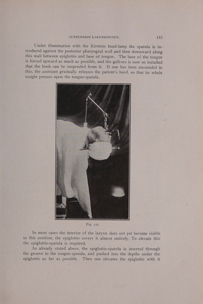 Under illumination with the Kirstein head-lamp the spatula is in- troduced against the posterior pharyngeal wall and then downward along this wall between epiglottis and base of tongue. ‘The base of the tongue is forced upward as much as possible, and the gallows is now so installed that the hook can be suspended from it. If one has been successful in this, the assistant gradually releases the patient’s head, so that its whole weight presses upon the tongue-spatula. In most cases the interior of the larynx does not yet become visible in this position, the epiglottis covers it almost entirely. To elevate this the epiglottis-spatula is required. As already stated above, the epiglottis-spatula is inserted through the groove in the tongue-spatula, and pushed into the depths under the epiglottis as far as possible. Then one elevates the epiglottis with it