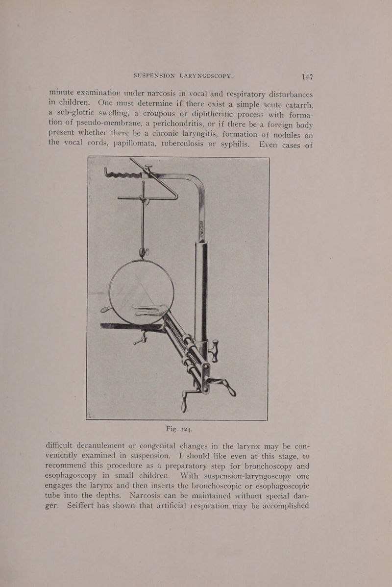 minute examination under narcosis in vocal and respiratory disturbances in children. One must determine if there exist a simple acute catarrh, a sub-glottic swelling, a croupous or diphtheritic process with forma- tion of pseudo-membrane, a perichondritis, or if there be a foreign body present whether there be a chronic laryngitis, formation of nodules on the vocal cords, papillomata, tuberculosis or syphilis. Even cases of difficult decanulement or congenital changes in the larynx may be con- veniently examined in suspension. I should like even at this stage, to recommend this procedure as a preparatory step for bronchoscopy and esophagoscopy in small children. With suspension-laryngoscopy one engages the larynx and then inserts the bronchoscopic or esophagoscopic tube into the depths. Narcosis can be maintained without special dan- ger. Seiffert has shown that artificial respiration may be accomplished