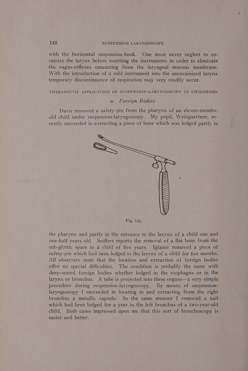 with the horizontal suspension-hook. One must never neglect to co- cainize the larynx before inserting the instruments in order to eliminate the vagus-reflexes emanating from the laryngeal mucous membrane. With the introduction of a cold instrument into the uncocainized larynx temporary discontinuance of respiration may very readily occur. THERAPEUTIC APPLICATION OF SUSPENSION-LARYNGOSCOPY IN CHILDHOOD. a. Foreign Bodies. Davis removed a safety-pin from the pharynx of an eleven-months- old child under suspension-laryngoscopy. My pupil, Weingaertner, re- cently succeeded in extracting a piece of bone which was lodged partly in the pharynx and partly in the entrance to the larynx of a child one and one-half years old. Seiffert reports the removal of a flat bone from the sub-glottic space in a child of five years. Iglauer removed a piece of safety-pin which had been lodged in the larynx of a child for five months. All observers state that the location and extraction of foreign bodies offer no special difficulties. The condition is probably the same with deep-seated foreign bodies whether lodged in the esophagus or in the larynx or bronchus. A tube is projected into these organs—a very simple procedure during suspension-laryngoscopy. By means of suspension- laryngoscopy I succeeded in locating in and extracting from the right bronchus a metallic capsule. In the same manner I removed a nail which had been lodged for a year in the left bronchus of a two-year-old child. Both cases impressed upon me that this sort of bronchoscopy is easier and better.