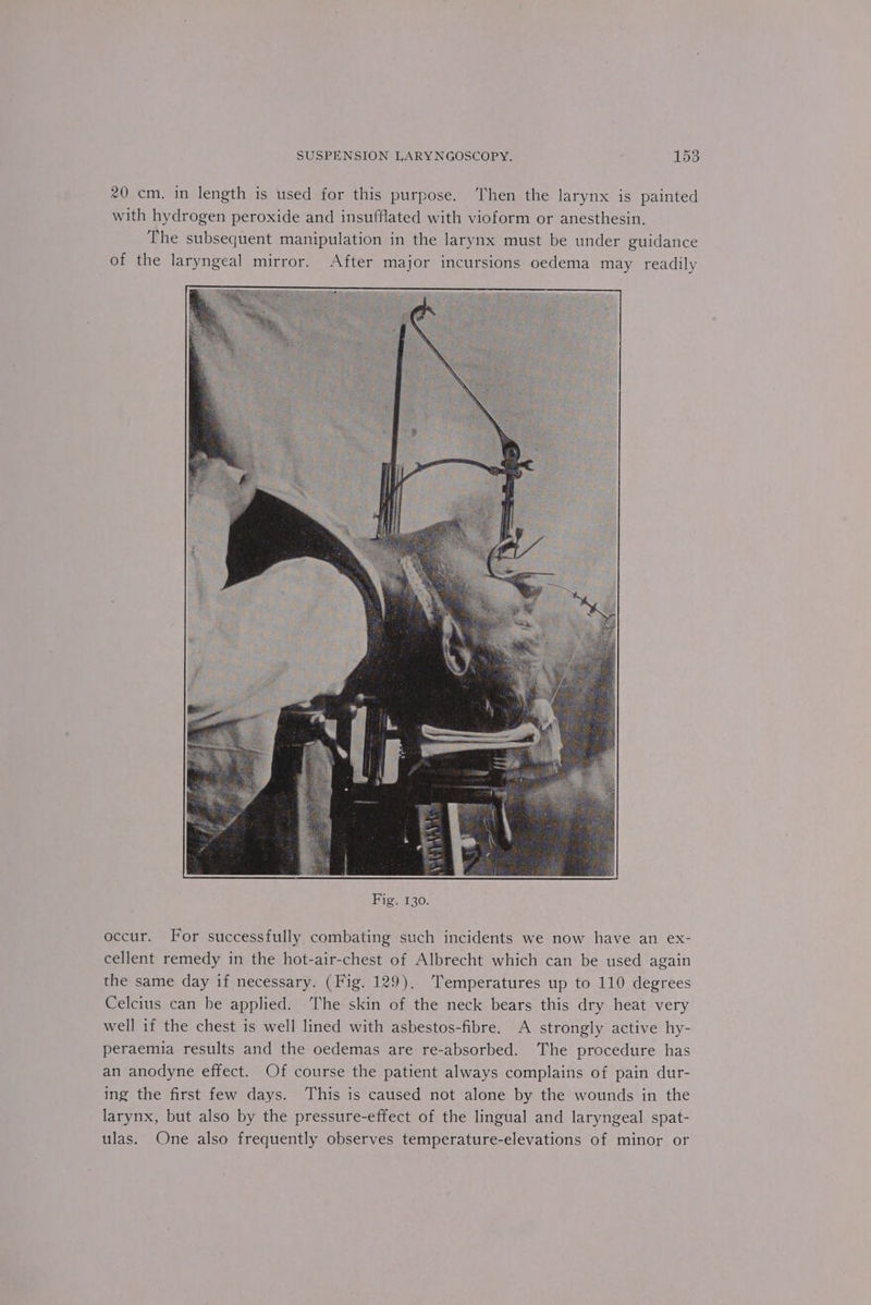 20 cm. in length is used for this purpose. ‘Then the larynx is painted with hydrogen peroxide and insufflated with vioform or anesthesin. The subsequent manipulation in the larynx must be under guidance of the laryngeal mirror. After major incursions oedema may readily occur. For successfully combating such incidents we now have an ex- cellent remedy in the hot-air-chest of Albrecht which can be used again the same day if necessary. (Fig. 129). Temperatures up to 110 degrees Celcius can be applied. The skin of the neck bears this dry heat very well if the chest is well lined with asbestos-fibre. A strongly active hy- peraemia results and the oedemas are re-absorbed. The procedure has an anodyne effect. Of course the patient always complains of pain dur- ing the first few days. This is caused not alone by the wounds in the larynx, but also by the pressure-effect of the lingual and laryngeal spat- ulas. One also frequently observes temperature-elevations of minor or