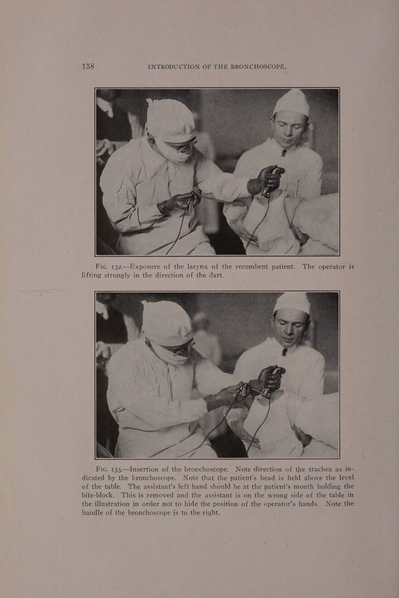 Fic. 132.—Exposure of the larynx of the recumbent patient. The operator is lifting strongly in the direction of the dart. Fic. 133.—Insertion of the bronchoscope. Note direction of the trachea as in- dicated by the bronchoscope. Note that the patient's head is held above the level of the table. The assistant’s left hand should be at the patient’s mouth holding the bite-block. This is removed and the assistant is on the wrong side of the table in the illustration in order not to hide the position of the operator’s hands. Note the handle of the bronchoscope is to the right.