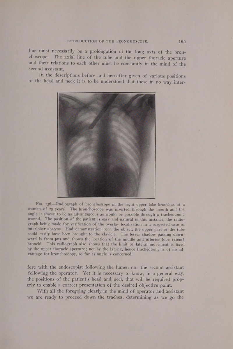 line must necessarily be a prolongation of the long axis of the bron- choscope. ‘The axial line of the tube and the upper thoracic aperture and their relations to each other must be constantly in the mind of the second assistant. In the descriptions before and hereafter given of various positions of the head and neck it is to be understood that these in no way inter- Fic. 136.—Radiograph of bronchoscope in the right upper lobe bronchus of a woman of 25 years. The bronchoscope was inserted through the mouth and the angle is shown to be as advantageous as would be possible through a tracheotomic wound. The position of the patient is easy and natural in this instance, the radio- graph being made for verification of the overlay localization in a suspected case of interlobar abscess. Had demonstration been the object, the upper part of the tube could easily have been brought to the clavicle. The lesser shadow passing down- ward is from pus and shows the location of the middle and inferior lobe (stem) bronchi. This radiograph also shows that the limit of lateral movement is fixed by the upper thoracic aperture; not by the larynx, hence tracheotomy is of no ad- vantage for bronchoscopy, so far as angle is concerned. fere with the endoscopist following the lumen nor the second assistant following the operator. Yet it is necessary to know, in a general way, the positions of the patient’s head and neck that will be required prop- erly to enable a correct presentation of the desired objective point. With all the foregoing clearly in the mind of operator and assistant we are ready to proceed down the trachea, determining as we go the