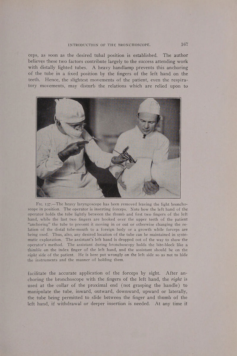 ceps, as soon as the desired tubal position is established. The author believes these two factors contribute largely to the success attending work with distally lighted tubes. A heavy handlamp prevents this anchoring of the tube in a fixed position by the fingers of the left hand on the teeth. Hence, the slightest movements of the patient, even the respira- tory movements, may disturb the relations which are relied upon to Fic. 137.—The heavy laryngoscope has been removed leaving the light broncho- scope in position. The operator is inserting forceps. Note how the left hand of the operator holds the tube lightly between the thumb and first two fingers of the left hand, while the last two fingers are hooked over the upper teeth of the patient “anchoring” the tube to prevent it moving in or out or otherwise changing the re- lation of the distal tube-mouth to a foreign body or a growth while forceps are being used. Thus, also, any desired location of the tube can be maintained in syste- matic exploration. The assistant’s left hand is dropped out of the way to show the operator’s method. The assistant during bronchoscopy holds the bite-block like a thimble on the index finger of the left hand, and the assistant should be on the right side of the patient. He is here put wrongly on the left side so as not to hide the instruments and the manner of holding them. facilitate the accurate application of the forceps by sight. After an- choring the bronchoscope with the fingers of the left hand, the right is used at the collar of the proximal end (not grasping the handle) to manipulate the tube, inward, outward, downward, upward or laterally, the tube being permitted to slide between the finger and thumb of the left hand, if withdrawal or deeper insertion is needed. At any time it