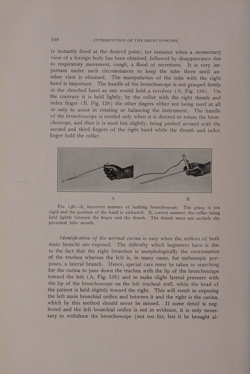 is instantly fixed at the desired point; for instance when a momentary view of a foreign body has been obtained, followed by disappearance due to respiratory movement, cough, a flood of secretions. It is very im- portant under such circumstances to keep the tube there until an- other view is obtained. The manipulation of the tube with the right hand is important. The handle of the bronchoscope is not grasped firmly in the clenched hand as one would hold.a revolver (A, Fig. 138). On the contrary it is held lightly, by the collar with the right thumb and index finger (B, Fig. 138) the other fingers either not being used at all or only to assist in rotating or balancing the instrument. ‘The handle of the bronchoscope is needed only when it is desired to rotate the bron- choscope, and then it is used but slightly, being pushed around with the second and third fingers of the right hand while the thumb and index finger hold the collar, Fic, 138—A, incorrect manner of holding bronchoscope. The grasp is too rigid and the position of the hand is awkward. B, correct manner, the collar being held lightly between the finger and the thumb. The thumb must not occlude the proximal tube mouth. Identification of the normal carina is easy when the orifices of both main bronchi are exposed. he difficulty which beginners have is due to the fact that the right bronchus is morphologically the continuation of the trachea whereas the left is, in many cases, for endoscopic pur- poses, a lateral branch. Hence, special care must be taken in searching for the carina to pass down the trachea with the lip of the bronchoscope toward the left (A, Fig. 139) and to make slight lateral pressure with the lip of the bronchoscope on the left tracheal wall, while the head of the patient is held slightly toward the right. This will result in exposing the left main bronchial orifice and between it and the right is the carina, which by this method should never be missed. If some detail is neg- lected and the left bronchial orifice is not in evidence, it is only neces- sary to withdraw the bronchoscope (not too far, lest it be brought al-