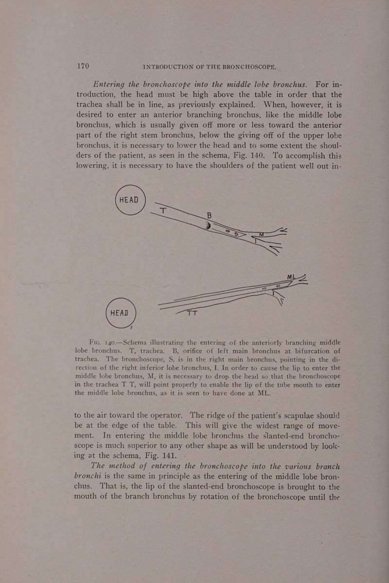 Entering the bronchoscope into the middle lobe bronchus. For in- troduction, the head must be high above the table in order that the trachea shall be in line, as previously explained. When, however, it is desired to enter an anterior branching bronchus, like the middle lobe bronchus, which is usually given off more or less toward the anterior part of the right stem bronchus, below the giving off of the upper lobe bronchus, it is necessary to lower the head and to some extent the shoul- ders of the patient, as seen in the schema, Fig. 140. To accomplish this lowering, it is necessary to have the shoulders of the patient well out in- $ Fic. 140.—Schema illustrating the entering of the anteriorly branching middle lobe bronchus. TT, trachea. B, orifice of left main bronchus at bifurcation of trachea. The bronchoscope, S, is in the right main bronchus, pointing in the di- rection of the right inferior lobe bronchus, I. In order to cause the lip to enter the middle lobe bronchus, M, it is necessary to drop the head so that the bronchoscope in the trachea T T, will point properly to enable the lip of the tube mouth to enter the middle lobe bronchus, as it is seen to have done at ML. to the air toward the operator. The ridge of the patient’s scapulae should be at the edge of the table. This will give the widest range of move- ment. In entering the middle lobe bronchus the slanted-end broncho- scope is much superior to any other shape as will be understood by look- ing at the schema, Fig. 141. The method of entering the bronchoscope into the various branch bronchi is the same in principle as the entering of the middle lobe bron- chus. ‘That is, the lip of the slanted-end bronchoscope is brought to the mouth of the branch bronchus by rotation of the bronchoscope until the