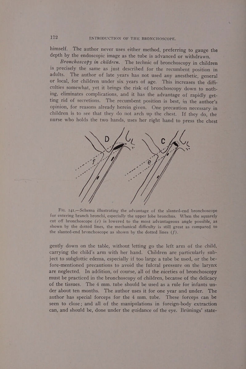 himself. The author never uses either method, preferring to gauge the depth by the endoscopic image as the tube is advanced or withdrawn. Bronchoscopy in children. ‘The technic of bronchoscopy in children is precisely the same as just described for the recumbent position in adults. The author of late years has not used any anesthetic, general or local, for children under six years of age. ‘This increases the diffi- culties somewhat, yet it brings the risk of bronchoscopy down to noth- ing, eliminates complications, and it has the advantage of rapidly get- ting rid of secretions. The recumbent position is best, in the author’s opinion, for reasons already herein given. One precaution necessary in children is to see that they do not arch up the chest. If they do, the nurse who holds the two hands, uses her right hand to press the chest Fic. 141.—Schema illustrating the advantage of the slanted-end bronchoscope for entering branch bronchi, especially the upper lobe bronchus. When the squarely cut off bronchoscope (e) is lowered to the most advantageous angle possible, as shown by the dotted lines, the mechanical difficulty is still great as compared to the slanted-end bronchoscope as shown by the dotted lines (f). gently down on the table, without letting go the left arm of the child, carrying the child’s arm with her hand. Children are particularly sub- ject to subglottic edema, especially if too large a tube be used, or the be- fore-mentioned precautions to avoid the fulcral pressure on the larynx are neglected. In addition, of course, all of the niceties of bronchoscopy must be practiced in the bronchoscopy of children, because of the delicacy of the tissues. The 4 mm. tube should be used as a rule for infants un- der about ten months. The author uses it for one year and under. The author has special forceps for the 4 mm. tube. These forceps can be seen to close; and all of the manipulations in foreign-body extraction can, and should be, done under the guidance of the eye. Briinings’ state-