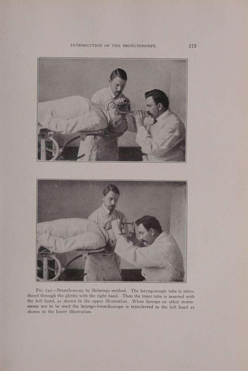 Fic. 142.—Bronchoscopy by Briinings method. The laryngoscopic tube is intro- duced through the glottis with the right hand. Then the inner tube is inserted with the left hand, as shown in the upper illustration. When forceps or other instru- ments are to be used the laryngo-bronchoscope is transferred to the left hand as shown in the lower illustration.