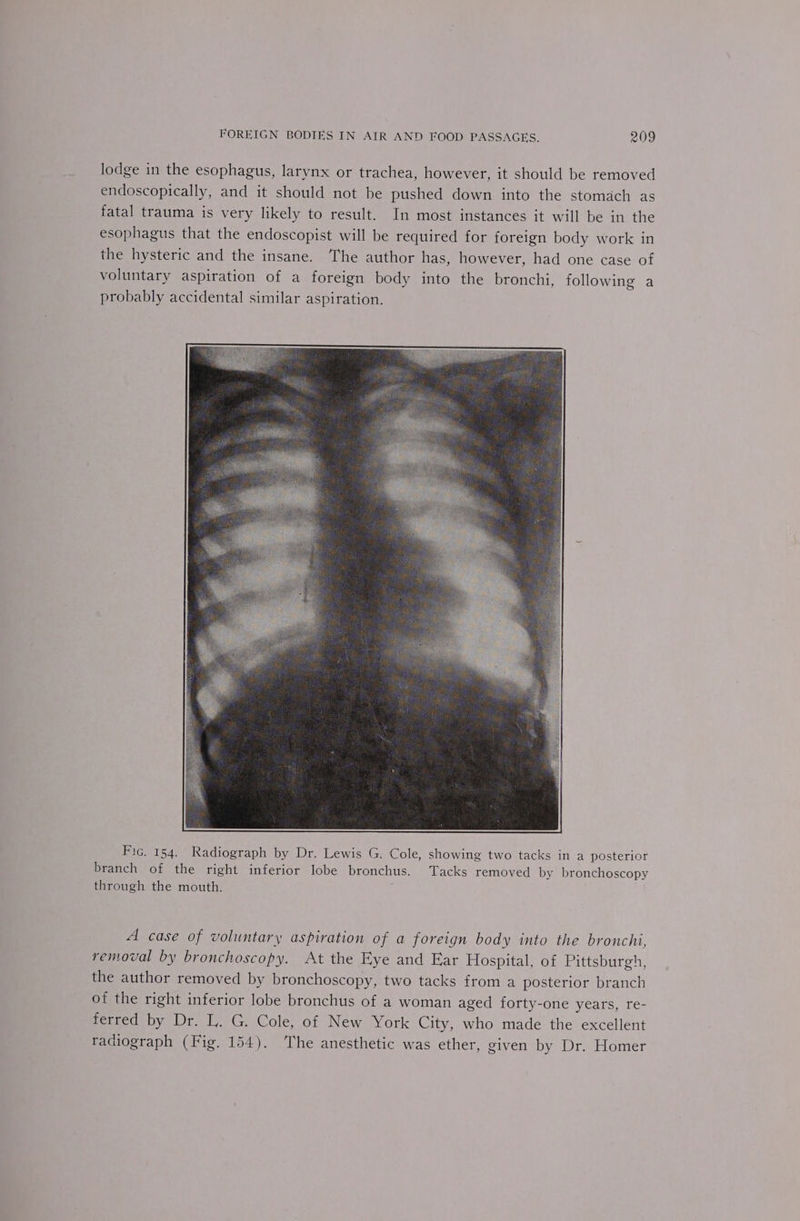 lodge in the esophagus, larynx or trachea, however, it should be removed endoscopically, and it should not be pushed down into the stomach as fatal trauma is very likely to result. In most instances it will be in the esophagus that the endoscopist will be required for foreign body work in the hysteric and the insane. The author has, however, had one case of voluntary aspiration of a foreign body into the bronchi, following a probably accidental similar aspiration. Fic. 154. Radiograph by Dr. Lewis G. Cole, showing two tacks in a posterior branch of the right inferior lobe bronchus. Tacks removed by bronchoscopy through the mouth. A case of voluntary aspiration of a foreign body into the bronchi, removal by bronchoscopy. At the Eye and Ear Hospital, of Pittsburgh, the author removed by bronchoscopy, two tacks from a posterior branch of the right inferior lobe bronchus of a woman aged forty-one years, re- ferred by Dr. L. G. Cole, of New York City, who made the excellent radiograph (Fig. 154). The anesthetic was ether, given by Dr. Homer