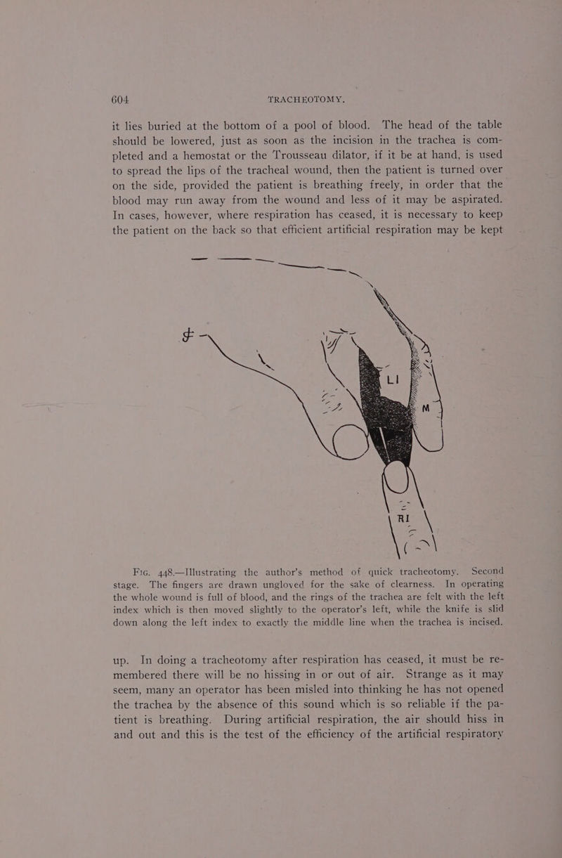 it lies buried at the bottom of a pool of blood. The head of the table should be lowered, just as soon as the incision in the trachea is com- pleted and a hemostat or the Trousseau dilator, if it be at hand, is used to spread the lips of the tracheal wound, then the patient is turned over on the side, provided the patient is breathing freely, in order that the blood may run away from the wound and less of it may be aspirated. In cases, however, where respiration has ceased, it is necessary to keep the patient on the back so that efficient artificial respiration may be kept Fic. 448—lIllustrating the author’s method of quick tracheotomy. Second stage. The fingers are drawn ungloved for the sake of clearness. In operating the whole wound is full of blood, and the rings of the trachea are felt with the left index which is then moved slightly to the operator’s left, while the knife is slid down along the left index to exactly the middle line when the trachea is incised. up. In doing a tracheotomy after respiration has ceased, it must be re- membered there will be no hissing in or out of air. Strange as it may seem, many an operator has been misled into thinking he has not opened the trachea by the absence of this sound which is so reliable if the pa- tient is breathing. During artificial respiration, the air should hiss in and out and this is the test of the efficiency of the artificial respiratory