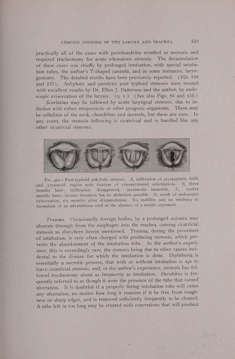 practically all of the cases with perichondritis resulted in necrosis and required tracheotomy for acute edematous stenosis. ‘The decannulation of these cases was chiefly by prolonged intubation, with special intuba- tion tubes, the author’s T-shaped cannula, and in some instances, laryn- gostomy. The detailed results have been previously reported. (Bib. 248 and 252). Ankylotic and paralytic post typhoid stenoses were treated with excellent results by Dr. Ellen J. Patterson and the author, by endo- scopic evisceration of the larynx. (q.v.) (See also Figs. 86 and 452.) Scarlatina may be followed by acute laryngeal stenosis, due to in- fection with either strepococcic or other pyogenic organisms. ‘There may be cellulitus of the neck, chondritus and necrosis, but these are rare. In any event, the stenosis following is cicatricial and is handled like any other cicatricial stenoses. Fic. 452——Post-typhoid ankylotic stenosis. A, infiltration of aryepiglottic folds and arytenoid region with fixation of cricoarytenoid articulations, B, three months later; infiltration disappeared, arytenoids immobile. C, twelve months later; tissues shrunken but no abduction possible. D, result of endoscopic evisceration, six months after decannulation. No mobility and no tendency to formation of an adventitious cord in the absence of a motile arytenoid. Trauma. Occasionally foreign bodies, by a prolonged sojourn may ulcerate through from the esophagus into the trachea, causing cicatricial stenosis as elsewhere herein mentioned. ‘Trauma, during the procedure of intubation, is very often charged with producing stenosis, which pre- vents the abandonment of the intubation tube. In the author’s experi- ence, this is exceedingly rare, the stenosis being due to other causes inci- dental to the disease for which the intubation is done. Diphtheria is essentially a necrotic process, that with or without intubation is apt to leave cicatricial stenosis, and, in the author’s experience, stenosis has fol- lowed tracheotomy about as frequently as intubation. Decubitus is fre- quently referred to as though it were the presence of the tube that caused ulceration. It is doubtful if a properly fitting intubation tube will cause any ulceration, no matter how long it remains if it be free from rough- ness or sharp edges, and is removed sufficiently frequently to be cleaned. A tube left in too long may be crusted with concretions that will produce