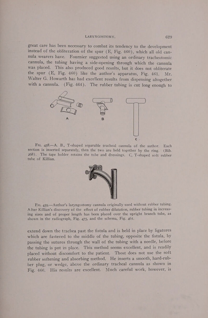 great care has been necessary to combat its tendency to the development instead of the obliteration of the spur (E, Fig. 460), which all old can- nula wearers have. Fournier suggested using an ordinary tracheotomic cannula, the tubing having a side-opening through which the cannula was placed. This also produced good results, but it does not obliterate the spur (E, Fig. 460) like the author’s apparatus, Fig. 461. Mr. Walter G. Howarth has had excellent results from dispensing altogether with a cannula. (Fig. 464). The rubber tubing is cut long enough to Cc Fic, 458—A. B., T-shaped separable tracheal cannula of the author. Each section is inserted separately, then the two are held together by the ring. (Bib. 268). The tape holder retains the tube and dressings. C, T-shaped soft rubber tube of Killian. Fic. 459.—Author’s laryngostomy cannula originally used without rubber tubing. After Killian’s discovery of the effect of rubber dilatation, rubber tubing in increas- ing sizes and of proper length has been placed over the upright branch tube, as shown in the radiograph, Fig. 475, and the schema, Fig. 461. extend down the trachea past the fistula and is held in place by ligatures which are fastened to the middle of the tubing, opposite the fistula, by passing the sutures through the wall of the tubing with a needle, before the tubing is put in place. This method seems excellent, and is readily placed without discomfort to the patient. Thost does not use the soft rubber softening and absorbing method. He inserts a smooth, hard-rub- ber plug, or wedge, above the ordinary tracheal cannula as shown in Fig. 466. His resuits are excellent. Much careful work, however, is