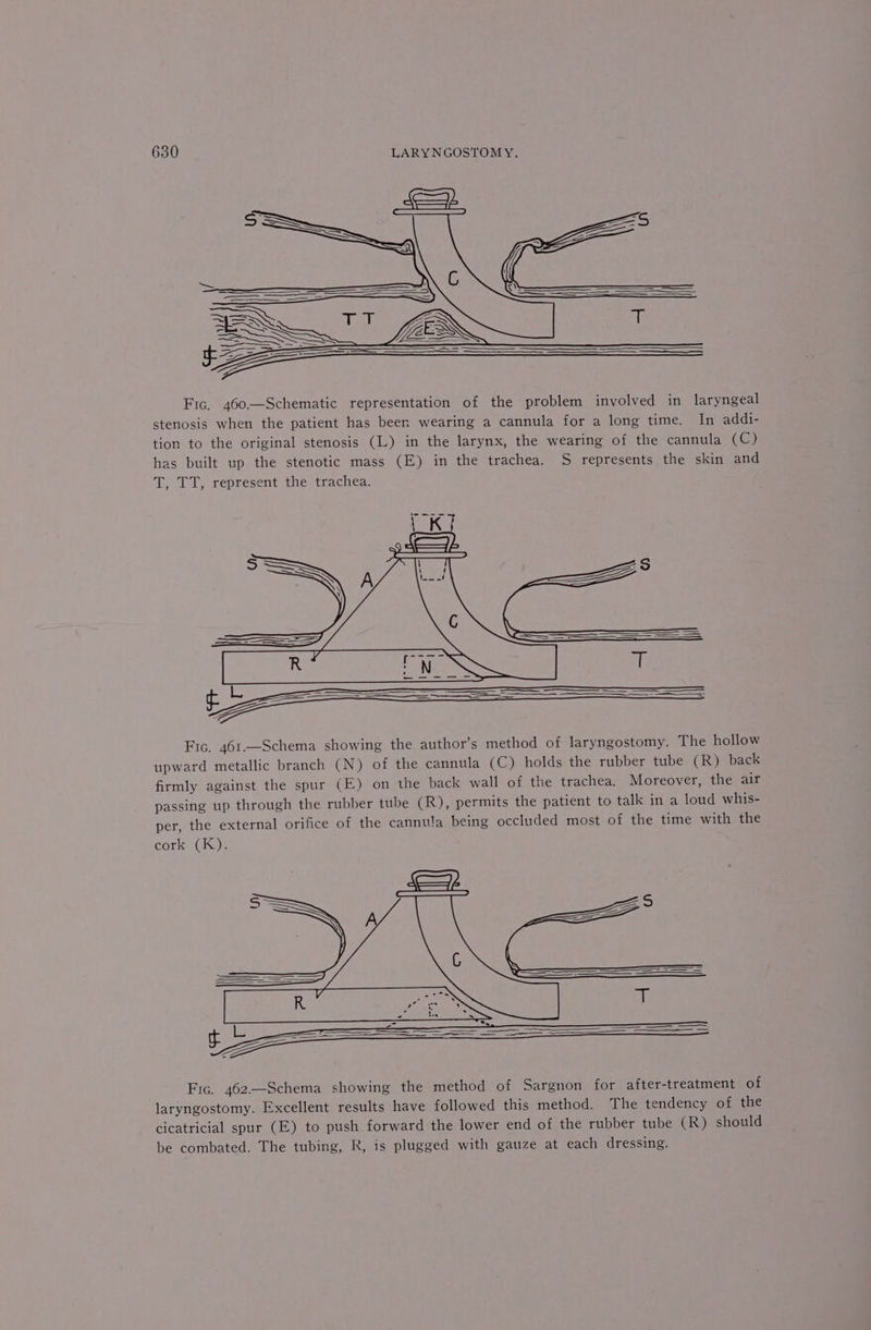 Fic, 460—Schematic representation of the problem involved in laryngeal stenosis when the patient has been wearing a cannula for a long time. In addi- tion to the original stenosis (L) in the larynx, the wearing of the cannula CC) has built up the stenotic mass (E) in the trachea. S represents the skin and T, TT, represent the trachea. Fic. 461—Schema showing the author’s method of laryngostomy. The hollow upward metallic branch (N) of the cannula (C) holds the rubber tube (R) back firmly against the spur (E) on the back wall of the trachea. Moreover, the air passing up through the rubber tube (R), permits the patient to talk in a loud whis- per, the external orifice of the cannula being occluded most of the time with the cork (K). Fic. 462—Schema showing the method of Sargnon for after-treatment of laryngostomy. Excellent results have followed this method. The tendency of the cicatricial spur (E) to push forward the lower end of the rubber tube (R) should be combated. The tubing, R, is plugged with gauze at each dressing.