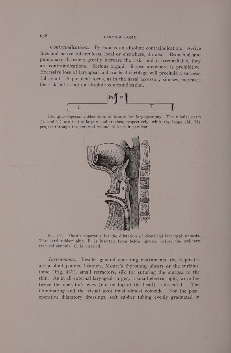 Contraindications. Pyrexia is an absolute contraindication. Active lues and active tuberculosis, local or elsewhere, do also. Bronchial and pulmonary disorders greatly increase the risks and if irremediable, they are contraindications. Serious organic disease anywhere is prohibitive. Excessive loss of laryngeal and tracheal cartilage will preclude a success- ful result. A purulent focus, as in the nasal accessory sinuses, increases the risk but is not an absolute contraindication. Fic, 465.—Special rubber tube of Moure for laryngostomy. The tubular parts (L and T) are in the larynx and trachea, respectively, while the loops (M, M) project through the external wound to keep it patulent. Fic. 466—Thost’s apparatus for the dilatation of cicatricial laryngeal stenosis. | The hard rubber plug, B, is inserted from below upward before the ordinary tracheal cannula, C, is inserted. Instruments. Besides general operating instruments, the requisites are a blunt pointed bistoury, Moure’s thyrotomy shears or the turbino- tome (Fig. 467), small retractors, silk for suturing the mucosa to the skin. As in all external laryngeal surgery a small electric light, worn be- tween the operator’s eyes (not on top of the head) is essential. The. illuminating and the visual axes must almost coincide. For the post- operative dilatatory dressings, soft rubber tubing evenly graduated in
