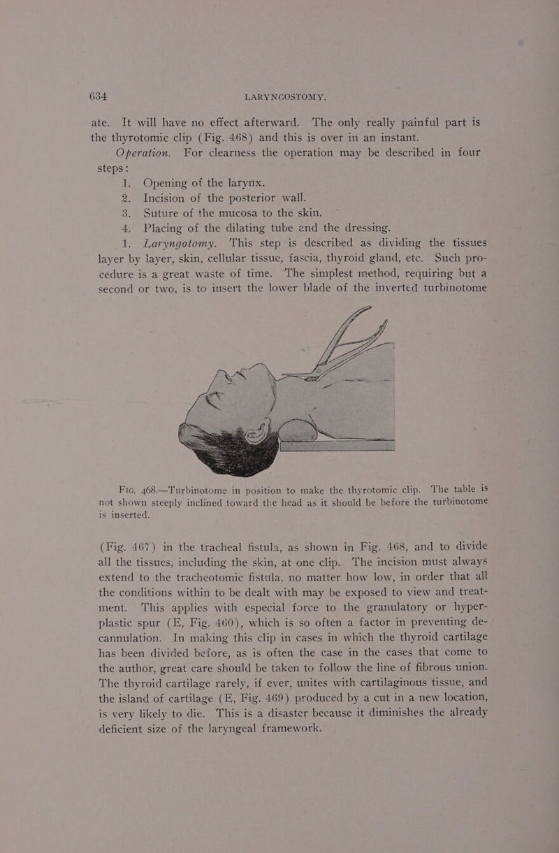 ate. It will have no effect afterward. The only really painful part is the thyrotomic clip (Fig. 468) and this is over in an instant. Operation. For clearness the operation may be described in four steps: Opening of the larynx. Incision of the posterior wall. Suture of the mucosa to the skin. Placing of the dilating tube and the dressing. Laryngotomy. This step is described as dividing the tissues layer layer, skin, cellular tissue, fascia, thyroid gland, etc. Such pro- cedure is a great waste of time. The simplest method, requiring but a second or two, is to insert the lower blade of the inverted turbinotome FS Con Cor Fic. 468.—Turbinotome in position to make the thyrotomic clip. The table is not shown steeply inclined toward the head as it should be before the turbinotome is inserted. (Fig. 467) in the tracheal fistula, as shown in Fig. 468, and to divide all the tissues, including the skin, at one clip. The incision must always extend to the tracheotomic fistula, no matter how low, in order that all the conditions within to be dealt with may be exposed to view and treat- ment. This applies with especial force to the granulatory or hyper- plastic spur (E, Fig. 460), which is so often a factor in preventing de- cannulation. In making this clip in cases in which the thyroid cartilage has been divided before, as is often the case in the cases that come to the author, great care should be taken to follow the line of fibrous union. The thyroid cartilage rarely, if ever, unites with cartilaginous tissue, and the island of cartilage (E, Fig. 469) produced by a cut in a new location, is very likely to die. This is a disaster because it diminishes the already deficient size of the laryngeal framework.