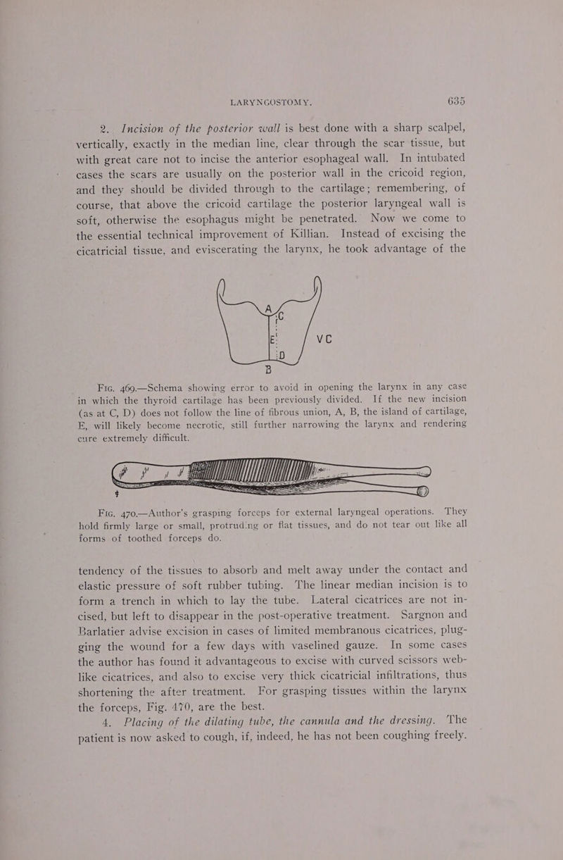 2. Incision of the posterior wall is best done with a sharp scalpel, vertically, exactly in the median line, clear through the scar tissue, but with great care not to incise the anterior esophageal wall. In intubated cases the scars are usually on the posterior wall in the cricoid region, and they should be divided through to the cartilage; remembering, of course, that above the cricoid cartilage the posterior laryngeal wall is soft, otherwise the esophagus might be penetrated. Now we come to the essential technical improvement of Killian. Instead of excising the cicatricial tissue, and eviscerating the larynx, he took advantage of the Fic. 469—Schema showing error to avoid in opening the larynx in any case in which the thyroid cartilage has been previously divided. If the new incision (as at C, D) does not follow the line of fibrous union, A, B, the island of cartilage, E, will likely become necrotic, still further narrowing the larynx and rendering cure extremely difficult. Fic. 470——Author’s grasping forceps for external laryngeal operations. They hold firmly large or small, protrud:ng or flat tissues, and do not tear out like all forms of toothed forceps do. tendency of the tissues to absorb and melt away under the contact and elastic pressure of soft rubber tubing. The linear median incision is to form a trench in which to lay the tube. Lateral cicatrices are not in- cised, but left to disappear in the post-operative treatment. Sargnon and Barlatier advise excision in cases of limited membranous cicatrices, plug- ging the wound for a few days with vaselined gauze. In some cases the author has found it advantageous to excise with curved scissors web- like cicatrices, and also to excise very thick cicatricial infiltrations, thus shortening the after treatment. For grasping tissues within the larynx the forceps, Fig. 470, are the best. 4. Placing of the dilating tube, the cannula and the dressing. The patient is now asked to cough, if, indeed, he has not been coughing freely.