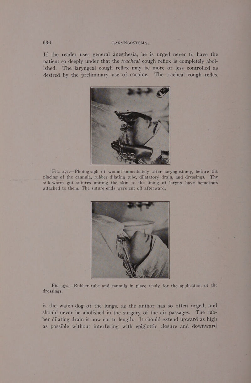 If the reader uses general anesthesia, he is urged never to have the patient so deeply under that the tracheal cough reflex is completely abol- ished. ‘The laryngeal cough reflex may be more or less controlled as desired. by the preliminary use of cocaine. The tracheal cough reflex Fic. 471—Photograph of wound immediately after laryngostomy, before the placing of the cannula, rubber dilating tube, dilatatory drain, and dressings. The silk-worm gut sutures uniting the skin to the lining of larynx have hemostats attached to them. The suture ends were cut off afterward. Fic. 472—Rubber tube and cannula in place ready for the application of the dressings. is the watch-dog of the lungs, as the author has so often urged, and should never be abolished in the surgery of the air passages. The rub- ber dilating drain is now cut to length. It should extend upward as high as possible without interfering with epiglottic closure and downward