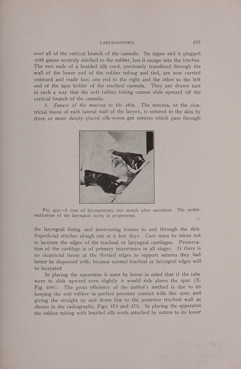 over all of the vertical branch of the cannula. Its upper end is plugged with gauze securely stitched to the rubber, lest it escape into the trachea. The two ends of a braided silk cord, previously transfixed through the wall of the lower end of the rubber tubing and tied, are now carried outward and made fast, one end to the right and the other to the left end of the tape holder of the tracheal cannula. They are drawn taut in such a way that the soft rubber tubing cannot slide upward off the vertical branch of the cannula. 3. Suture of the mucosa to the skin. The mucosa, or the cica- tricial tissue of each lateral wall of the larynx, is sutured to the skin by three or more deeply placed silk-worm gut sutures which pass through Fic. 473A case of laryngostomy one month after operation. The epider- matization of the laryngeal cavity is progressing. the laryngeal lining, and intervening tissues to and through the skin. Superficial stitches slough out in a few days. Care must be taken not to lacerate the edges of the tracheal or laryngeal cartilages. Preserva- tion of the cartilage is of primary importance in all stages. If there is no cicatricial tissue at the divided edges to support sutures they had better be dispensed with, because normal tracheal or laryngeal edges will be lacerated. In placing the apparatus it must be borne in mind that if the tube were to slide upward even slightly it would ride above the spur (E, Fig. 460). ‘The great efficiency of the author’s method is due to its keeping the soft rubber in perfect pressure contact with this spur, and giving the straight up and down line to the posterior tracheal wall as shown in the radiographs, Figs. 474 and 475. In placing the apparatus the rubber tubing with braided silk cords attached by suture to its lower