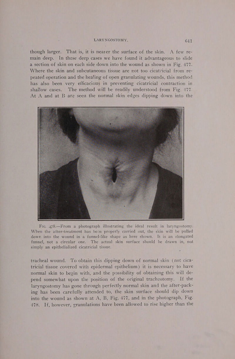 though larger. That is, it is nearer the surface of the skin. A few re- main deep. In these deep cases we have found it advantageous to slide a section of skin on each side down into the wound as shown in Fig. 477. Where the skin and subcutaneous tissue are not too cicatricial from re- peated operation and the healing of open granulating wounds, this method has also been very efficacious in preventing cicatricial contraction in shallow cases. The method will be readily understood from Fig. 477. At A and at B are seen the normal skin edges dipping down into the Fig. 478.—From a photograph illustrating the ideal result in laryngostomy. When the after-treatment has been properly carried out, the skin will be pulled down into the wound in a funnel-like shape as here shown. It is an elongated funnel, not a circular one. The actual skin surface should be drawn in simply an epithelialized cicatricial tissue. not ’ tracheal wound. ‘To obtain this dipping down of normal skin (not cica- tricial tissue covered with epidermal epithelium) it is necessary to have normal skin to begin with, and the possibility of obtaining this will de- pend somewhat upon the position of the original tracheotomy. If the laryngostomy has gone through perfectly normal skin and the after-pack- ing has been carefully attended to, the skin surface should dip down into the wound as shown at A, B, Fig. 477, and in the photograph, Fig. 478. If, however, granulations have been allowed to rise higher than the