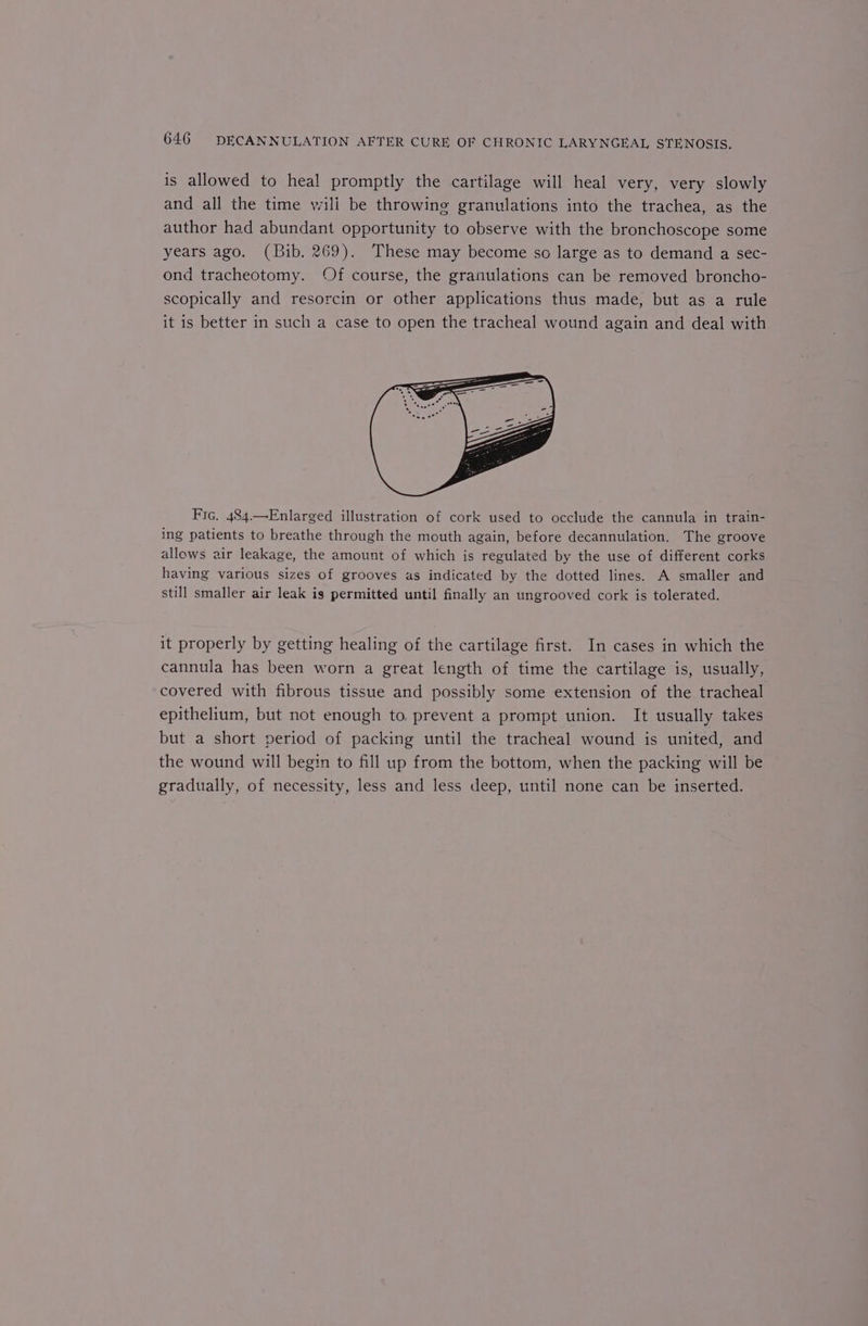 is allowed to heal promptly the cartilage will heal very, very slowly and all the time wili be throwine granulations into the trachea, as the author had abundant opportunity to observe with the bronchoscope some years ago. (Bib. 269). These may become so large as to demand a sec- ond tracheotomy. Of course, the granulations can be removed broncho- scopically and resorcin or other applications thus made, but as a rule it is better in such a case to open the tracheal wound again and deal with Fic. 484.—Enlarged illustration of cork used to occlude the cannula in train- ing patients to breathe through the mouth again, before decannulation. The groove allows air leakage, the amount of which is regulated by the use of different corks having various sizes of grooves as indicated by the dotted lines. A smaller and still smaller air leak is permitted until finally an ungrooved cork is tolerated. it properly by getting healing of the cartilage first. In cases in which the cannula has been worn a great length of time the cartilage is, usually, covered with fibrous tissue and possibly some extension of the tracheal epithelium, but not enough to. prevent a prompt union. It usually takes but a short period of packing until the tracheal wound is united, and the wound will begin to fill up from the bottom, when the packing will be gradually, of necessity, less and less deep, until none can be inserted.