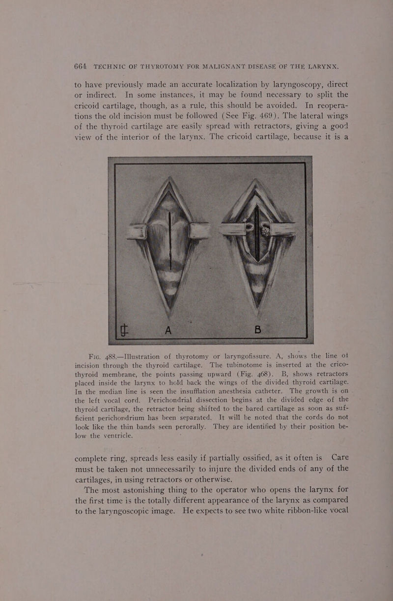 to have previously made an accurate localization by laryngoscopy, direct or indirect. In some instances, it may be found necessary to split the cricoid cartilage, though, as a rule, this should be avoided. In reopera- tions the old incision must be followed (See Fig. 469). The lateral wings of the thyroid cartilage are easily spread with retractors, giving a good view of the interior of the larynx. The cricoid cartilage, because it is a Fic. 488—lIllustration of thyrotomy or laryngofissure. A, shows the line of incision through the thyroid cartilage. The tubinotome is inserted at the crico- thyroid membrane, the points passing upward (Fig. 468). B, shows retractors placed inside the larynx to hold back the wings of the divided thyroid cartilage. In the median line is seen the insufflation anesthesia catheter. The growth is on the left vocal cord. Perichondrial dissection begins at the divided edge of the thyroid cartilage, the retractor being shifted to the bared cartilage as soon as suf- ficient perichondrium has been separated. It will be noted that the cords do not look like the thin bands seen perorally. They are identified by their position be- low the ventricle. . complete ring, spreads less easily if partially ossified, as it often is Care must be taken not unnecessarily to injure the divided ends of any of the cartilages, in using retractors or otherwise. The most astonishing thing to the operator who opens the larynx for the first time is the totally different appearance of the larynx as compared to the laryngoscopic image. He expects to see two white ribbon-like vocal