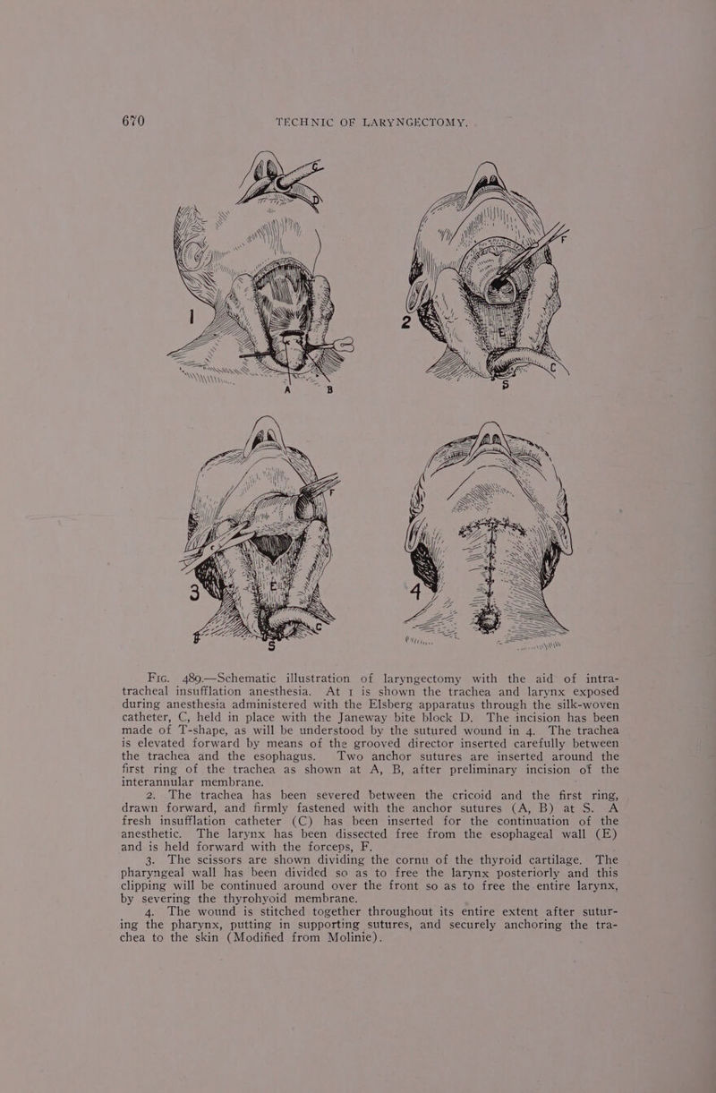 —— —— . MAAK AA aa, y= &gt;= Q = = WS sie oh ee \ \ WA AAS SWSARAQY \ ah ay yey! Fic. 489.—Schematic illustration of laryngectomy with the aid of intra- tracheal insufflation anesthesia. At 1 is shown the trachea and larynx exposed during anesthesia administered with the Elsberg apparatus through the silk-woven catheter, C, held in place with the Janeway bite block D. The incision has been made of T-shape, as will be understood by the sutured wound in 4. The trachea is elevated forward by means of the grooved director inserted carefully between the trachea and the esophagus. Two anchor sutures are inserted around the first ring of the trachea as shown at A, B, after preliminary incision of the interannular membrane. 2. The trachea has been severed between the cricoid and the first ring, drawn forward, and firmly fastened with the anchor sutures (A, B) at S. A fresh insufflation catheter (C) has been inserted for the continuation of the anesthetic. The larynx has been dissected free from the esophageal wall (E) and is held forward with the forceps, F. 3. The scissors are shown dividing the cornu of the thyroid cartilage. The pharyngeal wall has been divided so as to free the larynx posteriorly and this clipping will be continued around over the front so as to free the entire larynx, by severing the thyrohyoid membrane. 4. The wound is stitched together throughout its entire extent after sutur- ing the pharynx, putting in supporting sutures, and securely anchoring the tra- chea to the skin (Modified from Molinie).