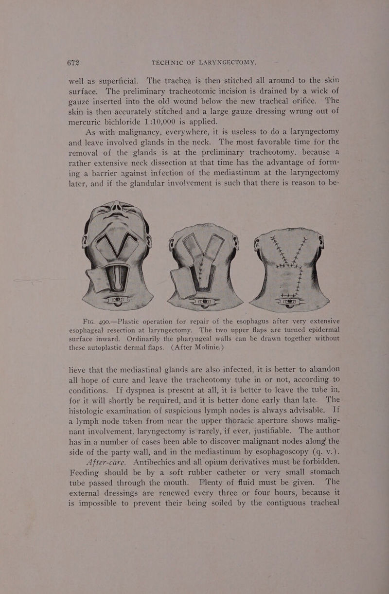 well as superficial. The trachea is then stitched all around to the skin surface. The preliminary tracheotomic incision is drained by a wick of gauze inserted into the old wound below the new tracheal orifice. ‘The skin is then accurately stitched and a large gauze dressing wrung out of mercuric bichloride 1:10,000 is applied. As with malignancy, everywhere, it is useless to do a laryngectomy and leave involved glands in the neck. The most favorable time for the removal of the glands is at the preliminary tracheotomy. because a rather extensive neck dissection at that time has the advantage of form- ing a barrier against infection of the mediastinum at the laryngectomy later, and if the glandular involvement is such that there is reason to be- Fic. 490.—Plastic operation for repair of the esophagus after very extensive esophageal resection at laryngectomy. The two upper flaps are turned epidermal surface inward. Ordinarily the pharyngeal walls can be drawn together without these autoplastic dermal flaps. (After Molinie.) lieve that the mediastinal glands are also infected, it is better to abandon all hope of cure and leave the tracheotomy tube in or not, according to conditions. If dyspnea is present at all, it is better to leave the tube ia, for it will shortly be required, and it is better done early than late. The histologic examination of suspicious lymph nodes is always advisable. If a lymph node taken from near the upper thoracic aperture shows malig- nant involvement, laryngectomy is rarely, if ever, justifiable. The author has in a number of cases been able to discover malignant nodes along the side of the party wall, and in the mediastinum by esophagoscopy (q. v.). After-care. Antibechics and all opium derivatives must be forbidden. Feeding should be by a soft rubber catheter or very small stomach tube passed through the mouth. Plenty of fluid must be given. The external dressings are renewed every three or four hours, because it is impossible to prevent their being soiled by the contiguous tracheal