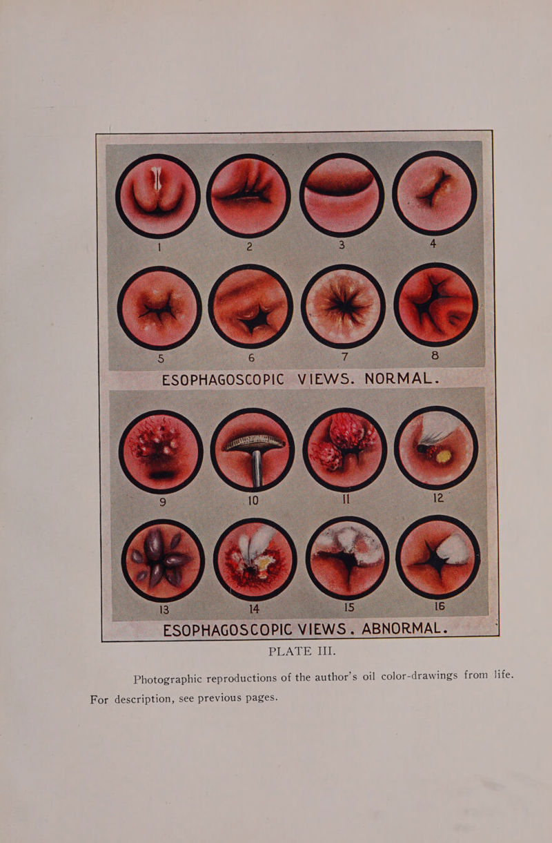 ESOPHAGOSCOPIC VIEWS. ABNORMAL. PEATE Photographic reproductions of the author’s oil color-drawings from life. For description, see previous pages.