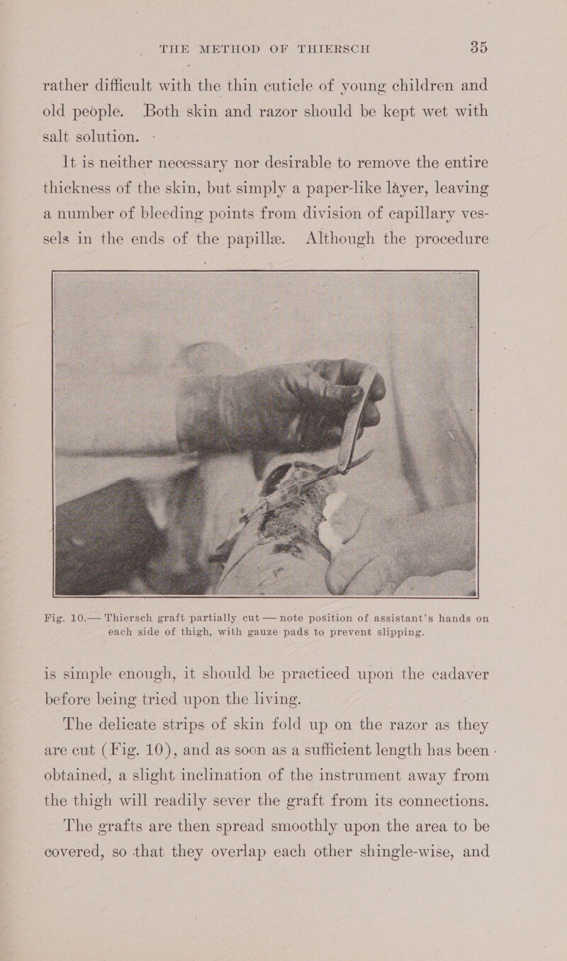 rather difficult with the thin cuticle of young children and old people. Both skin and razor should be kept wet with salt solution. It is neither necessary nor desirable to remove the entire thickness of the skin, but simply a paper-like layer, leaving a number of bleeding points from division of capillary ves- sels in the ends of the papilla. Although the procedure Fig. 10.— Thiersch graft partially eut — note position of assistant’s hands on each side of thigh, with gauze pads to prevent slipping. is simple enough, it should be practiced upon the cadaver before being tried upon. the living. The delicate strips of skin fold up on the razor as they are cut (Fig. 10), and as soon as a sufficient length has been - obtained, a slight inclination of the instrument away from the thigh will readily sever the graft from its connections. - The grafts are then spread smoothly upon the area to be covered, so that they overlap each other shingle-wise, and
