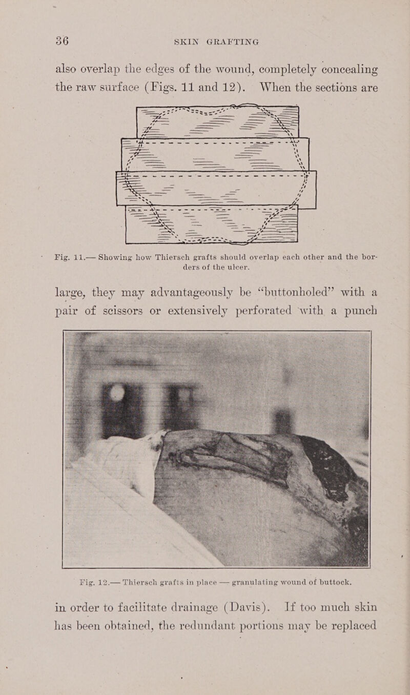 also overlap the edges of the wound, completely concealing the raw surface (Figs. 11 and 12). When the sections are Fig. 11.— Showing how Thiersch grafts should overlap each other and the bor- ders of the ulcer. large, they may advantageously be “buttonholed” with a pair of scissors or extensively perforated ‘with a punch in order to facilitate drainage (Davis). If too much skin has been obtained, the redundant portions may be replaced