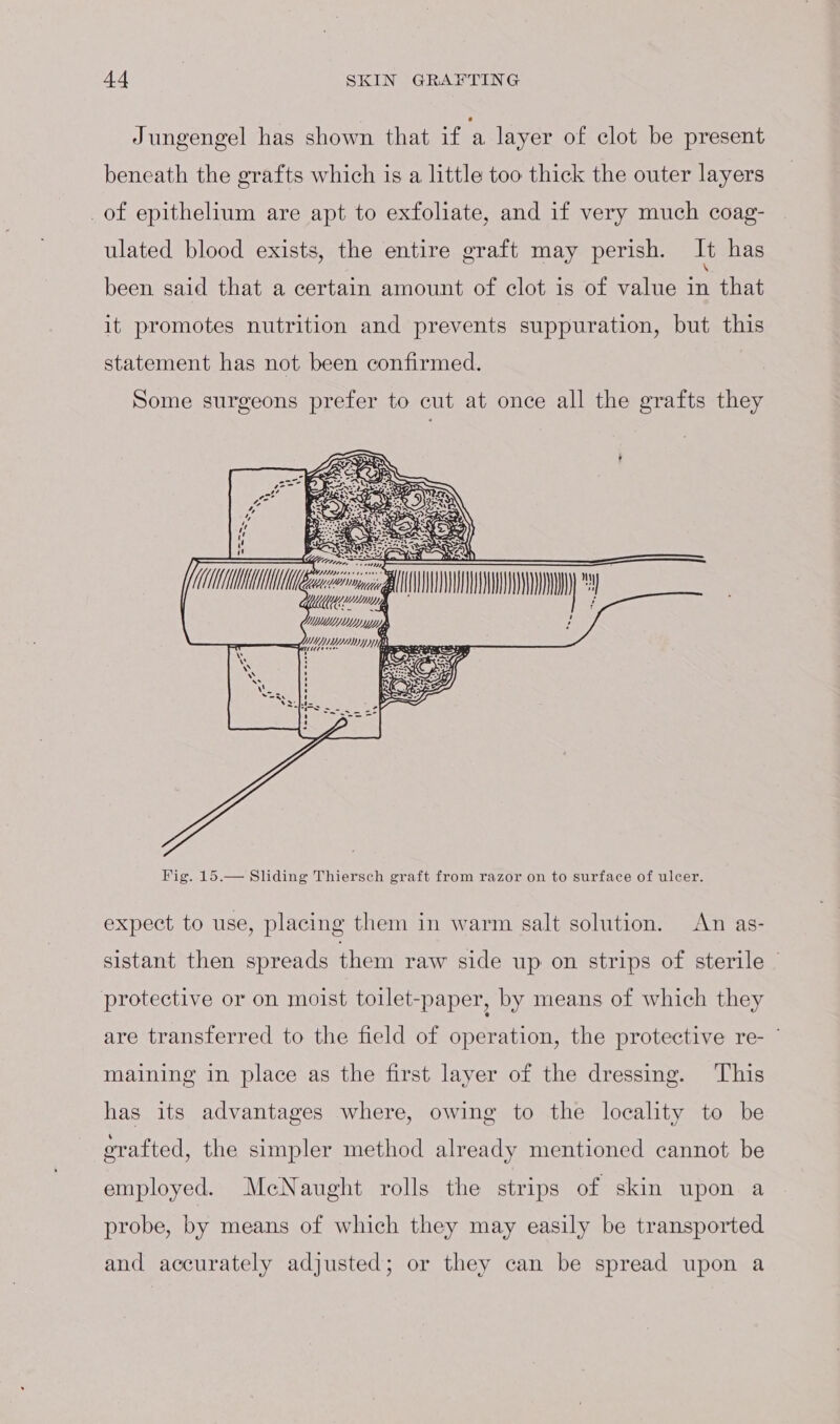 Jungengel has shown that if ‘a layer of clot be present beneath the grafts which is a little too thick the outer layers _of epithelium are apt to exfoliate, and if very much coag- ulated blood exists, the entire graft may perish. It has been said that a certain amount of clot is of value ae that it promotes nutrition and prevents suppuration, but this statement has not been confirmed. Some surgeons prefer to cut at once all the grafts they expect to use, placing them in warm salt solution. An as- sistant then spreads them raw side up on strips of sterile protective or on moist toilet-paper, by means of which they are transferred to the field of operation, the protective re- ° maining in place as the first layer of the dressing. ‘This has its advantages where, owing to the locality to be grafted, the simpler method already mentioned cannot be employed. McNaught rolls the strips of skin upon a probe, by means of which they may easily be transported and accurately adjusted; or they can be spread upon a